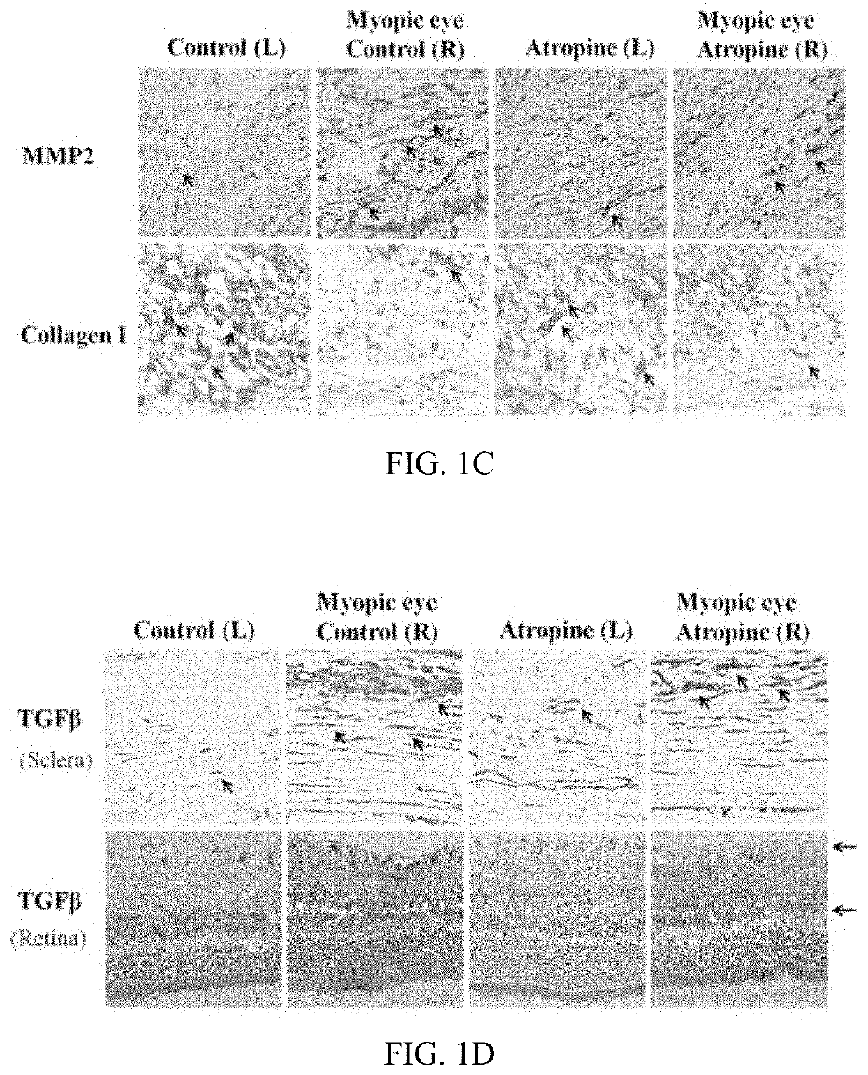 Method for treating and relieving myopia