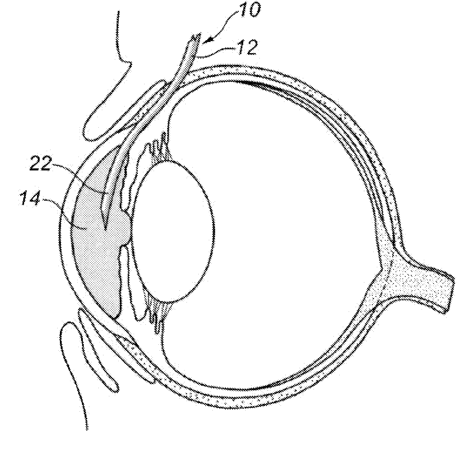 Shunt and Method Treatment of Glaucoma