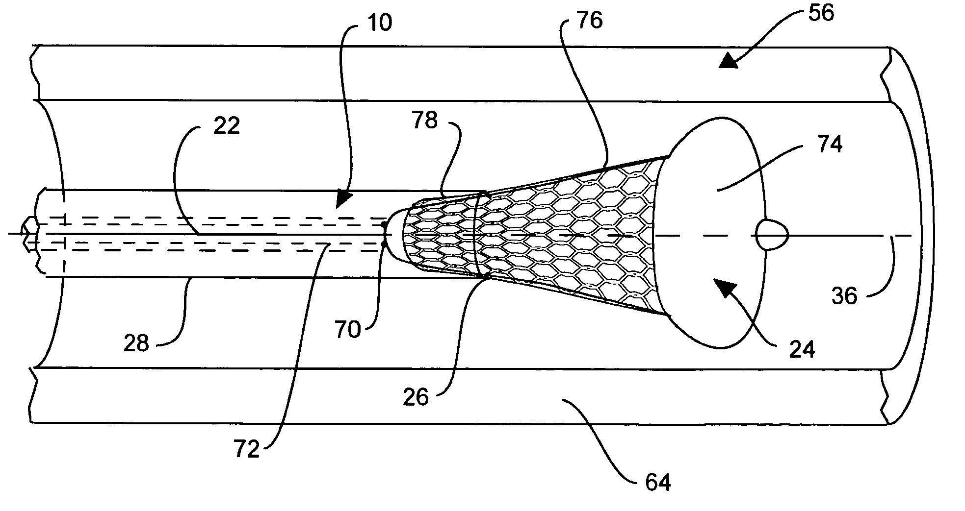 Intraluminal stent assembly and method of deploying the same