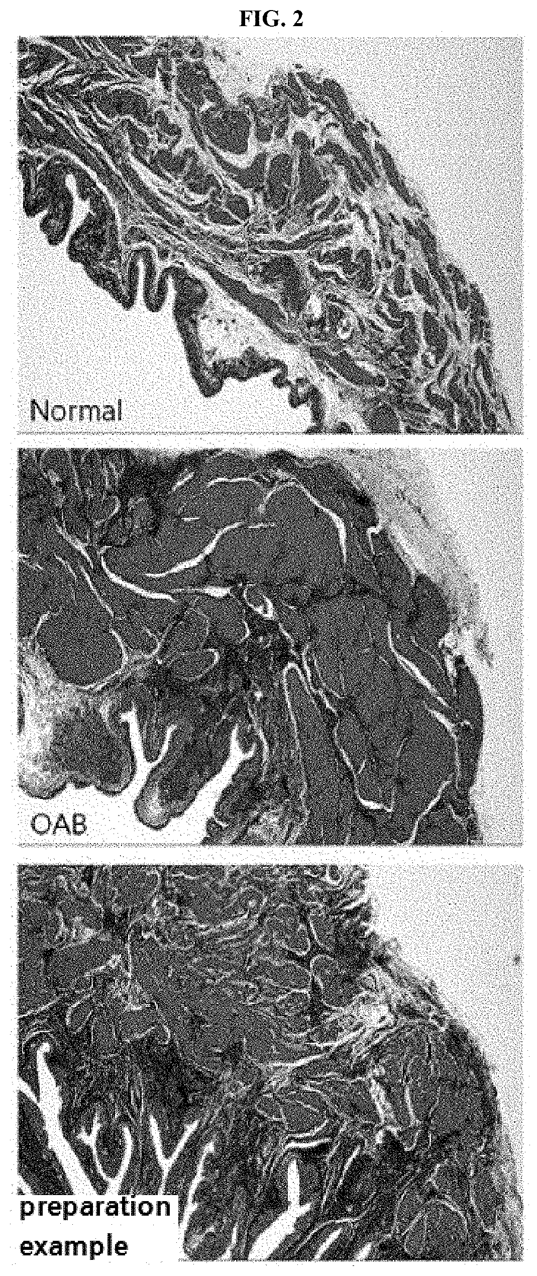 Pharmaceutical composition and dietary supplement for preventing or treating overactive bladder caused by secondary bladder degeneration due to bladder outlet obstruction caused by benign prostatic hyperplasia