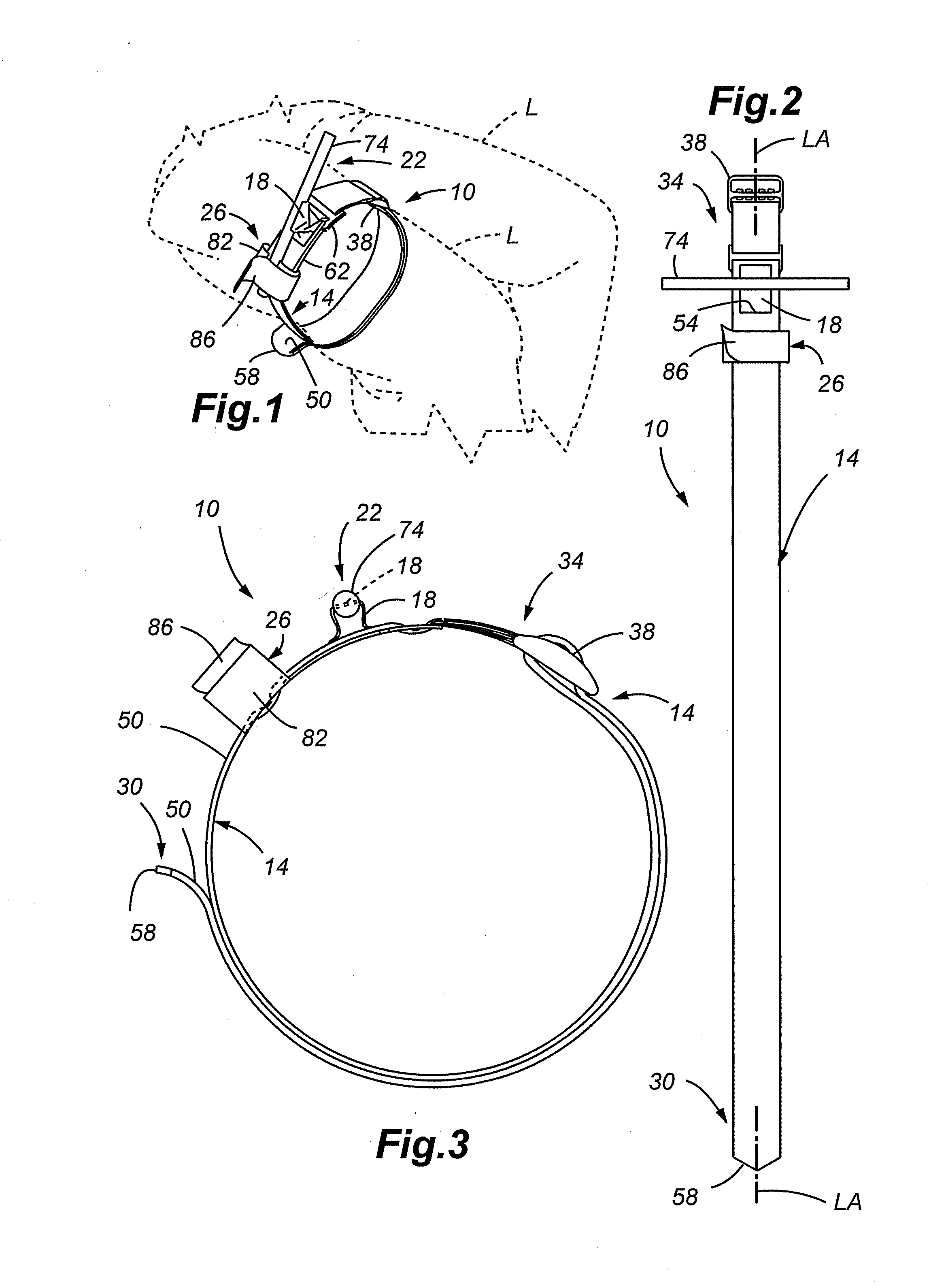 Tourniquet and method of use