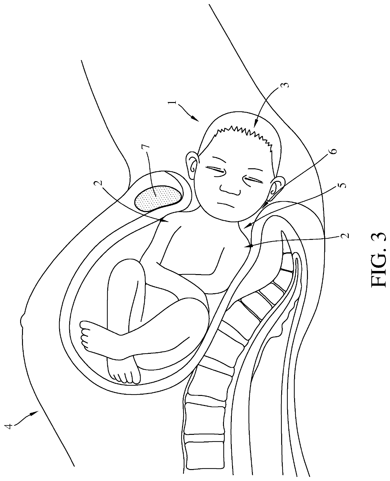 Delivery assistance tool for shoulder dystocia