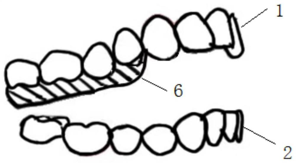 Tongue force occlusal force mediated invisible orthodontic device and manufacturing method