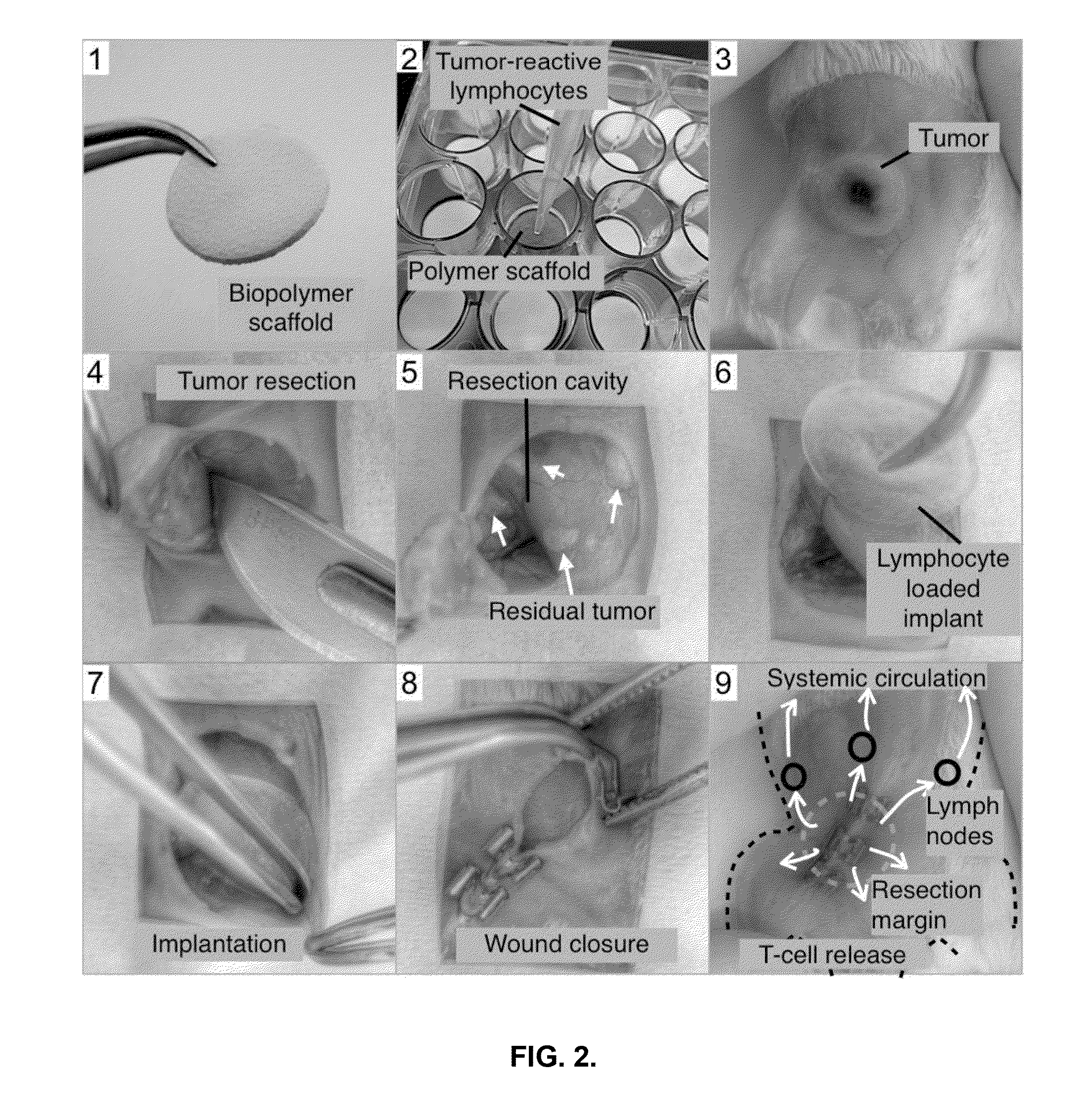 Compositions and methods for delivery of immune cells to treat un-resectable or non-resected tumor cells and tumor relapse