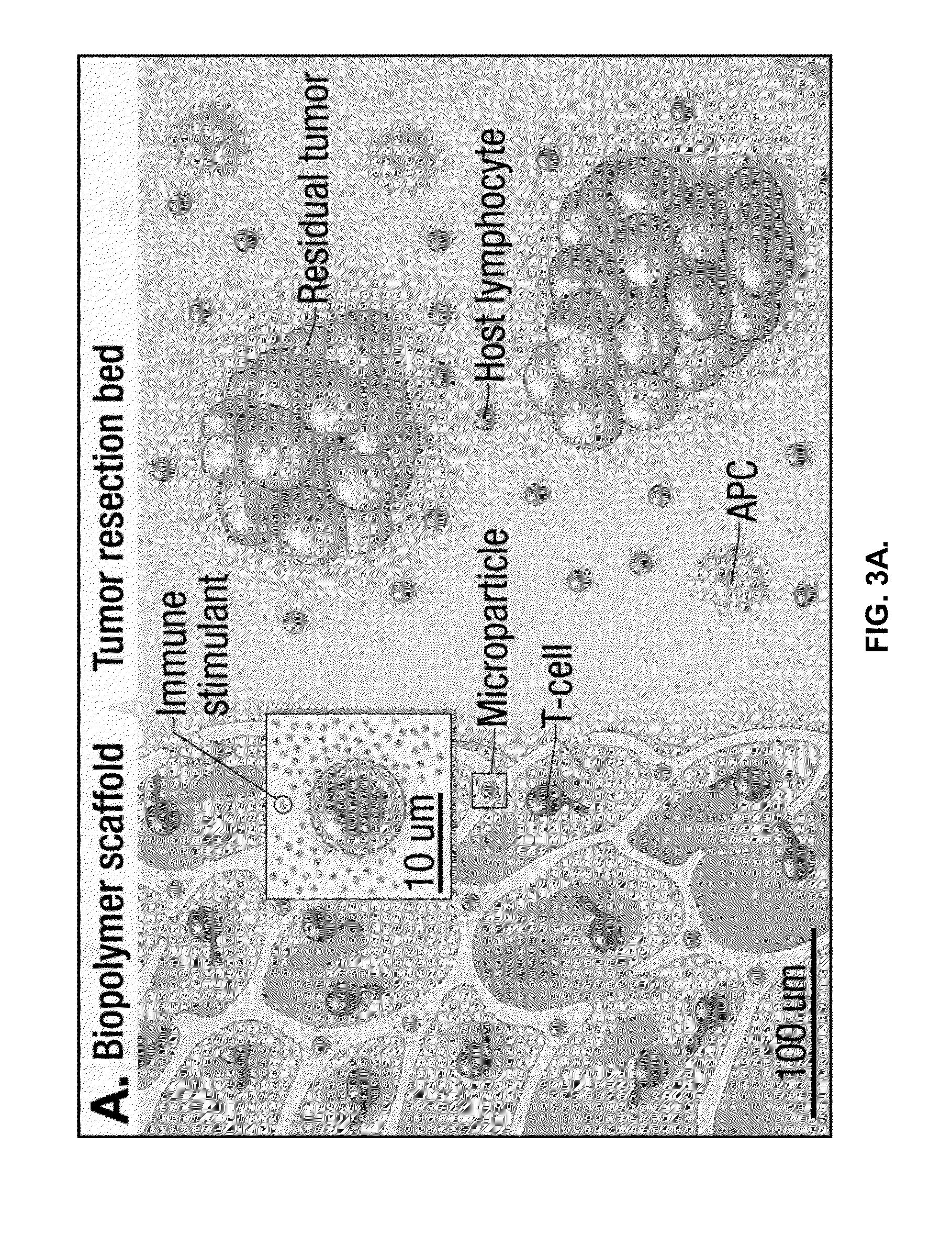 Compositions and methods for delivery of immune cells to treat un-resectable or non-resected tumor cells and tumor relapse