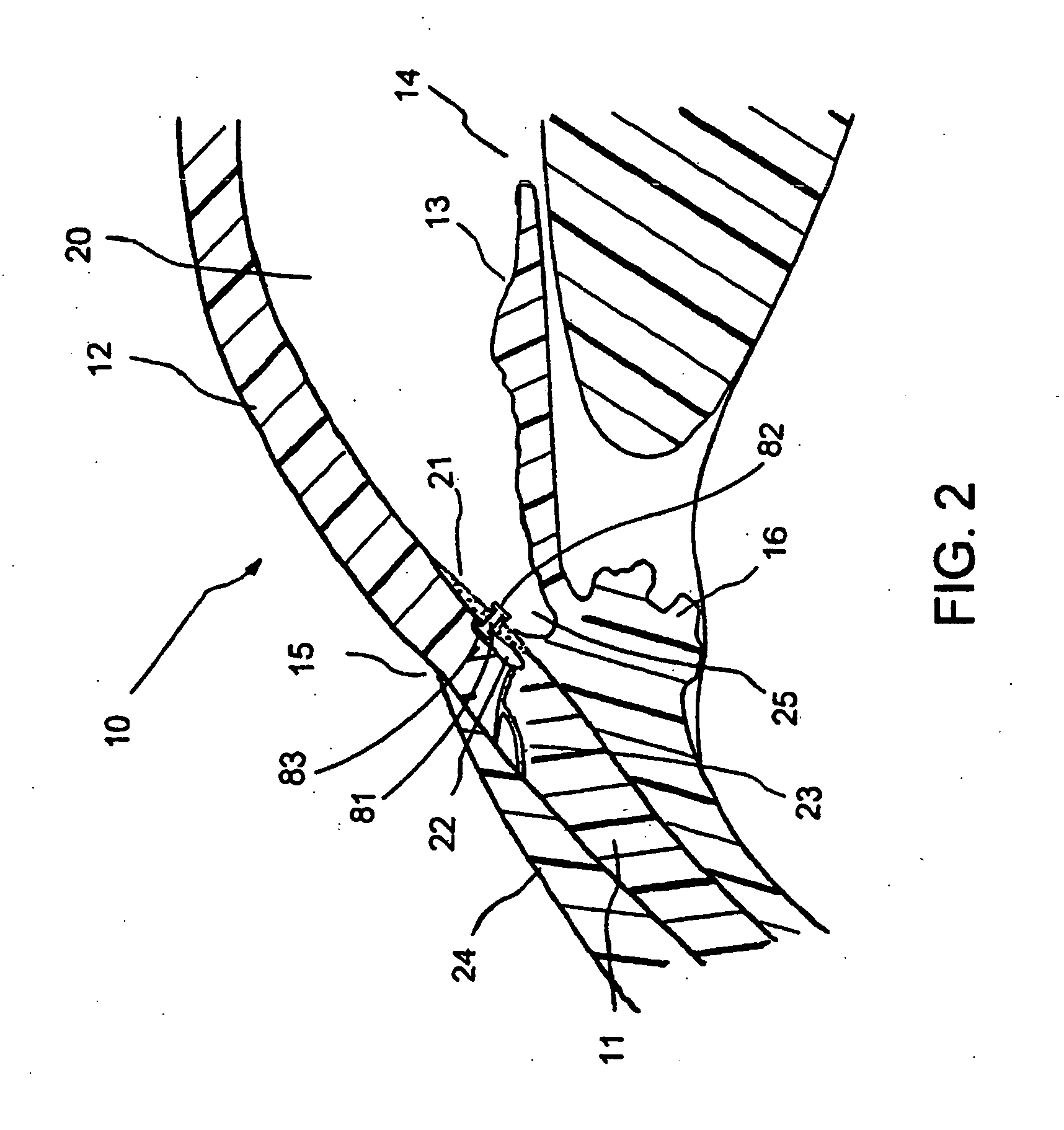 Aqueous outflow enhancement with vasodilated aqueous cavity