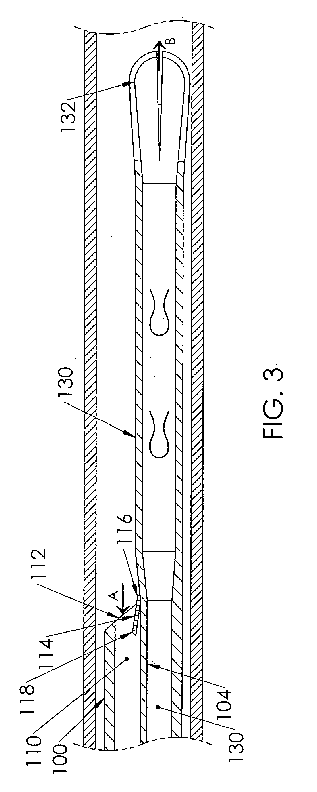 Security tip for vascular catheter and method of using same