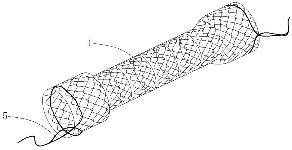 Fully-covered recoverable esophageal stent for promoting healing of anastomotic fistula