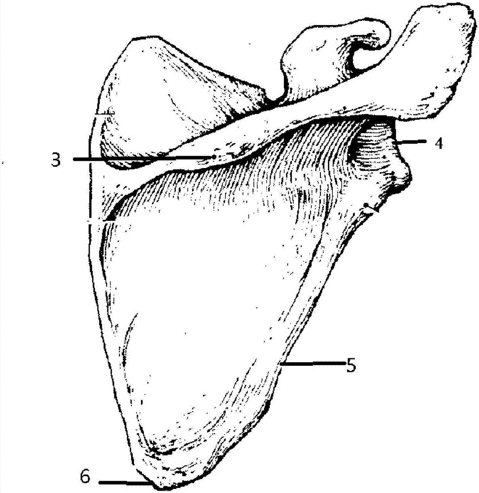 Scapula lateral border dissection locking plate for scapula fracture and application of locking plate