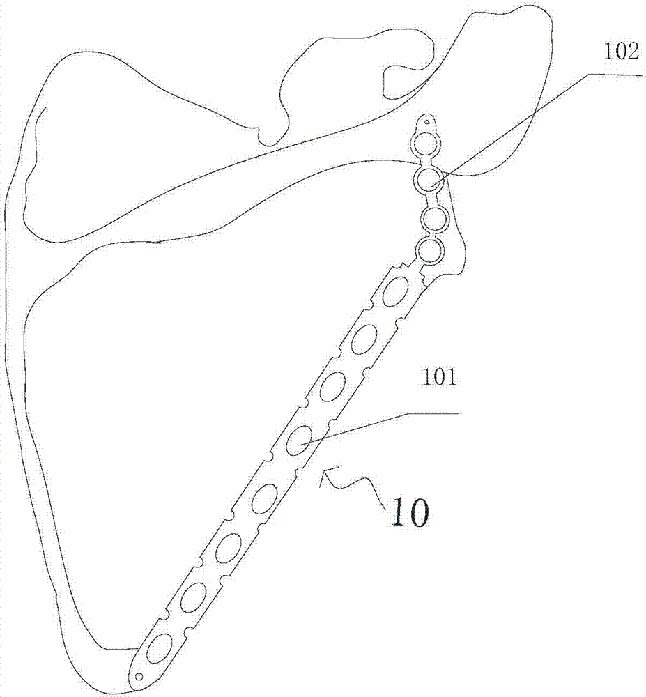 Scapula lateral border dissection locking plate for scapula fracture and application of locking plate