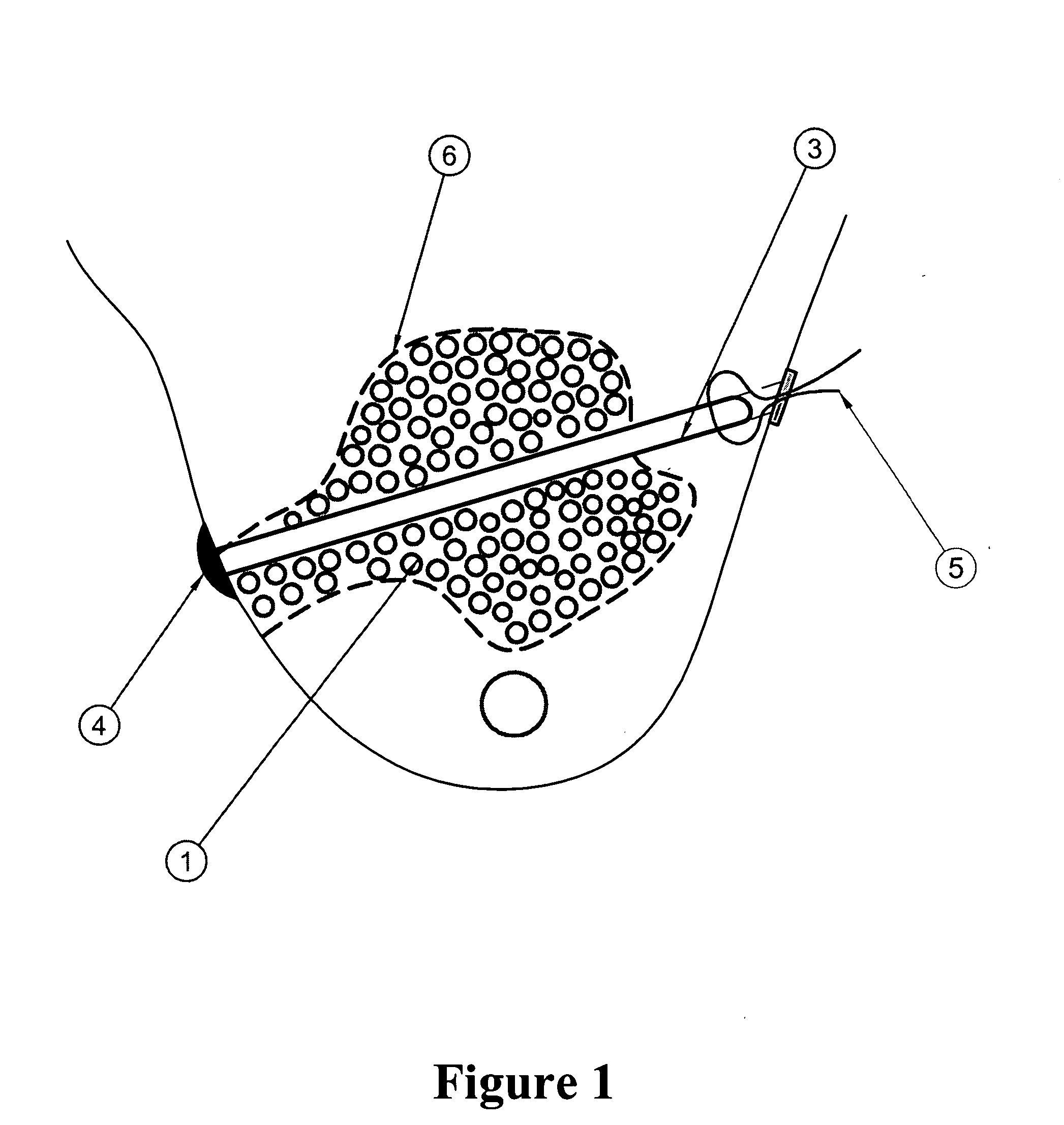 Brachytherapy applicator