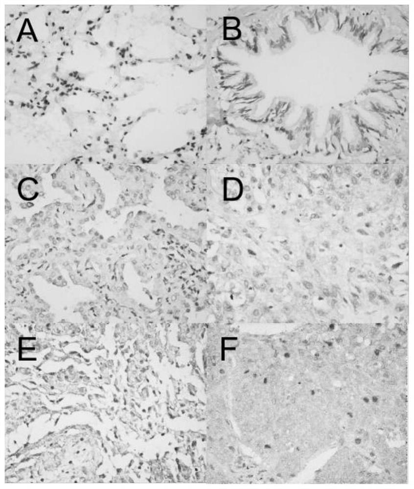 Application of TMOD3 and/or ADSL in non-small cell carcinoma