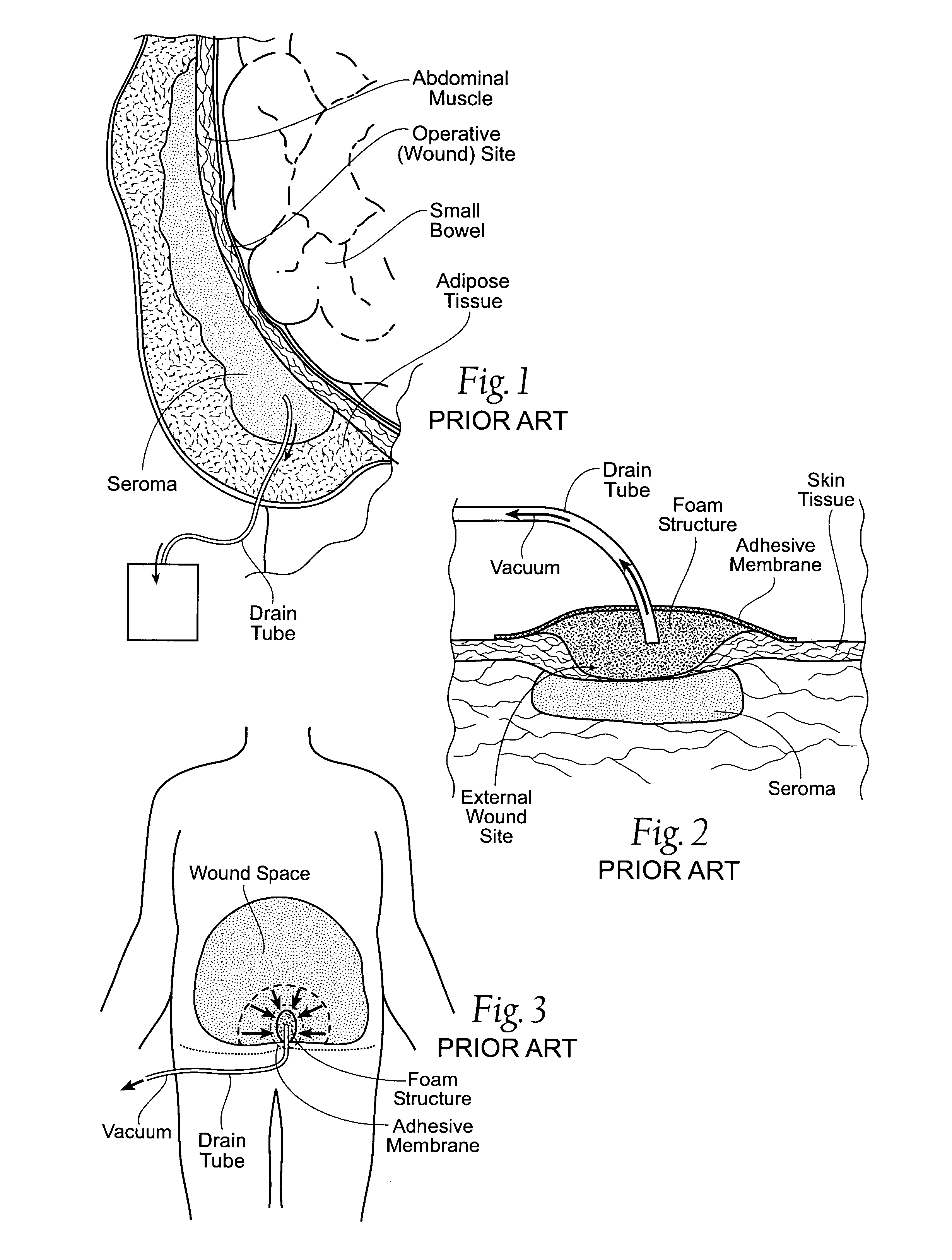 Assemblies, systems, and methods for vacuum assisted internal drainage during wound healing