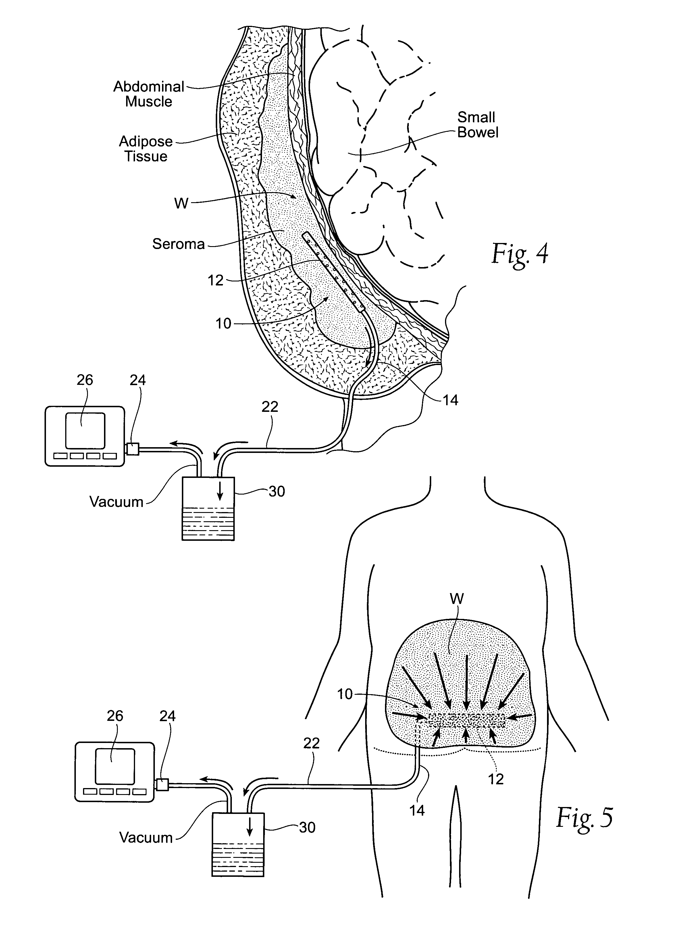 Assemblies, systems, and methods for vacuum assisted internal drainage during wound healing