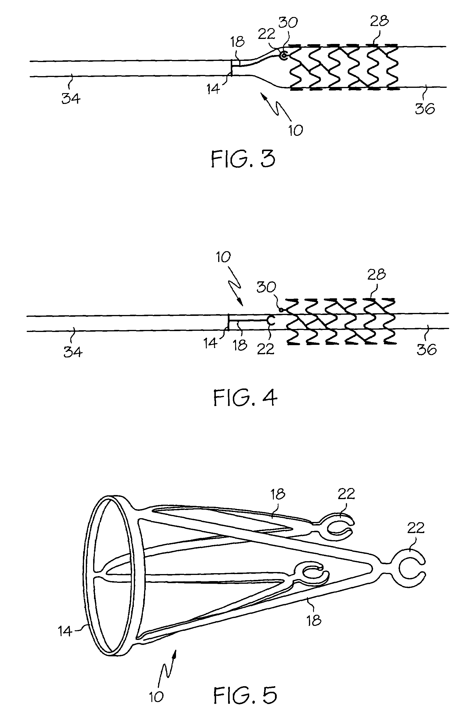 Mechanism to improve stent securement