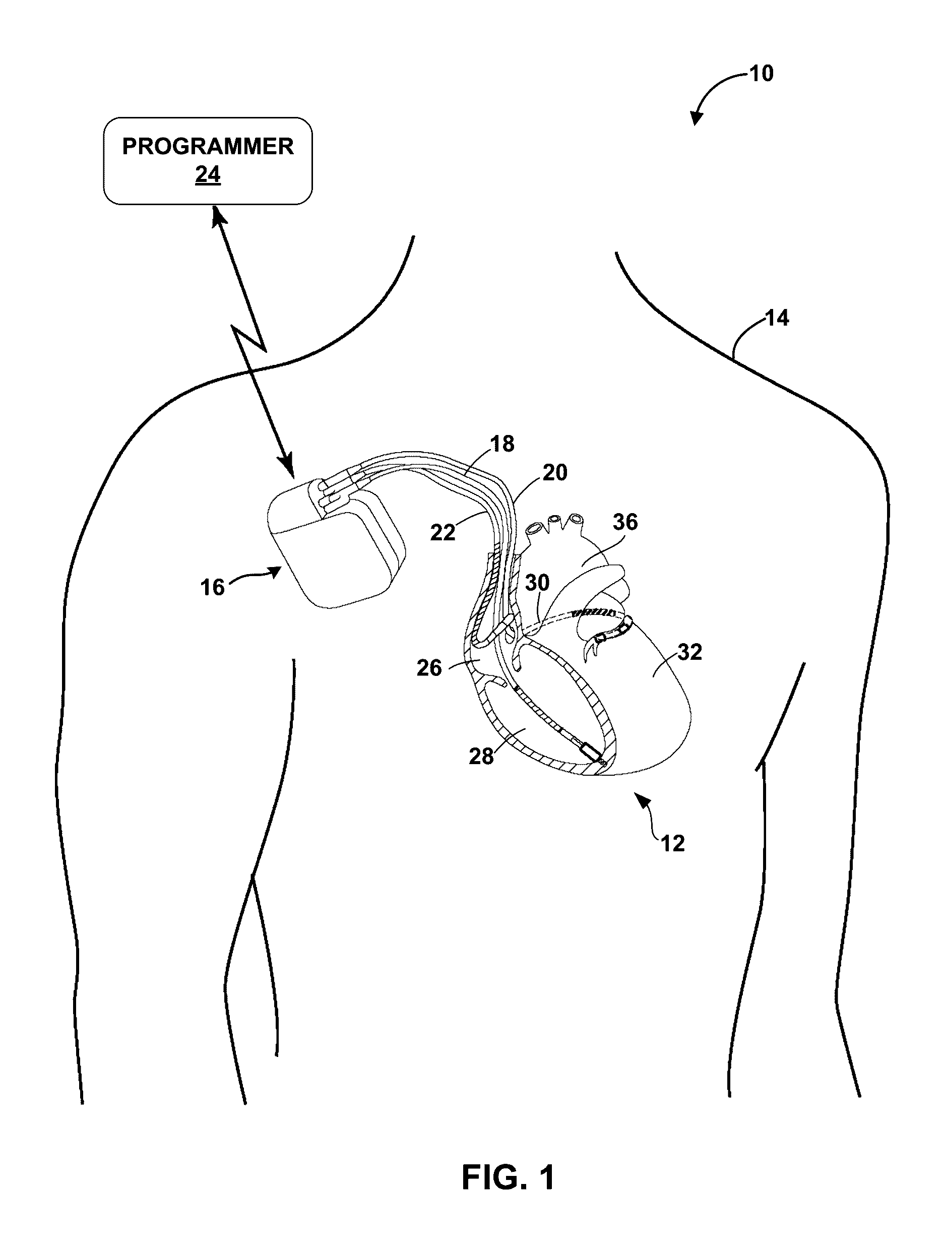 Av nodal stimulation during atrial tachyarrhythmia to prevent inappropriate therapy delivery