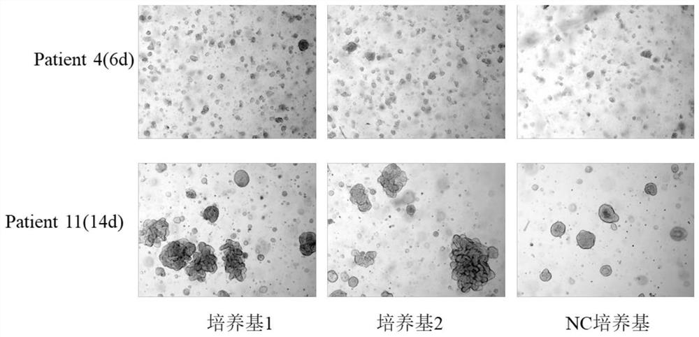 Culture medium for culturing recurrent renal cell carcinoma organoid and application of culture medium