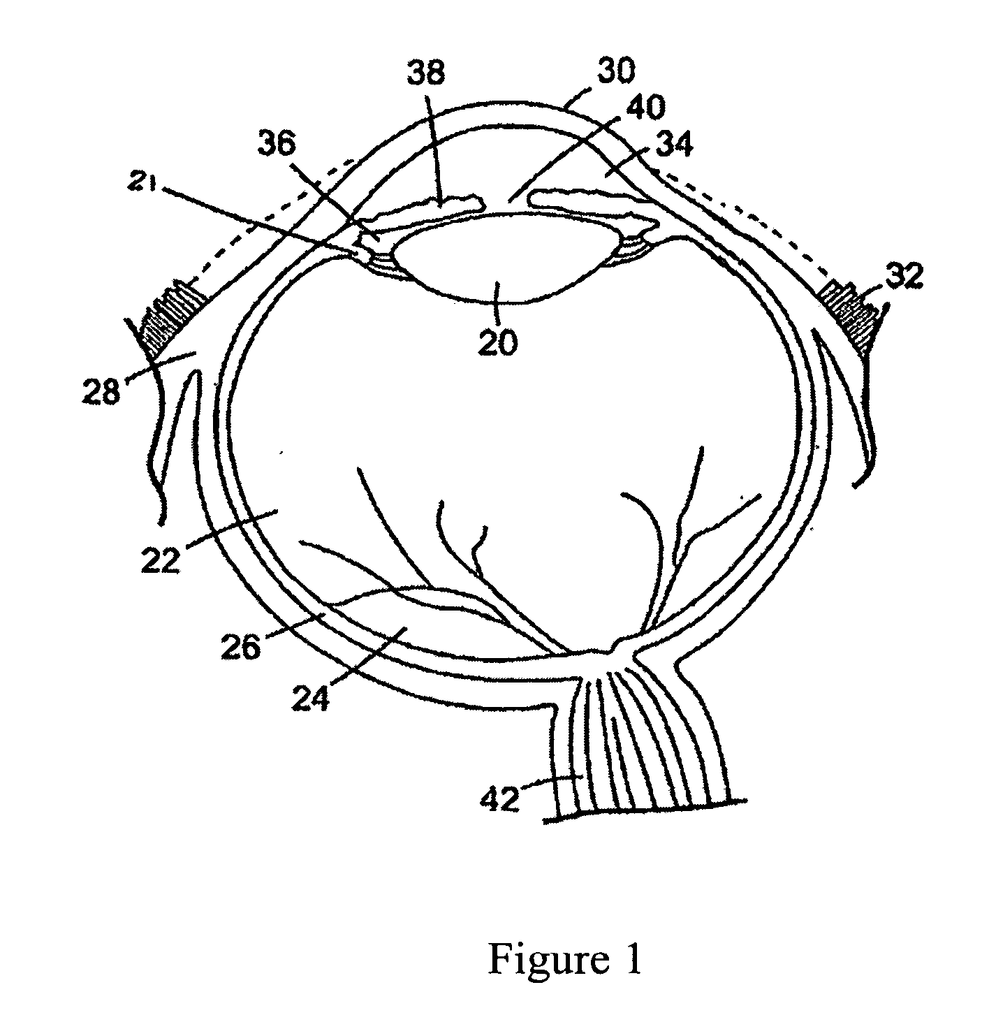 In VIVO formed matrices including natural biodegradale polysaccharides and ophthalmic uses thereof