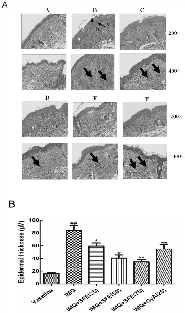 Medicine for treating psoriasis