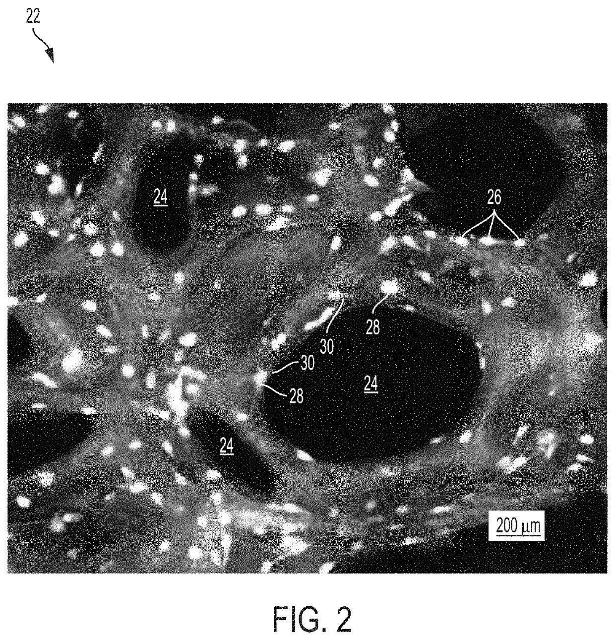 Treatment of skeletal voids with implantable substrate hydrated with bone marrow concentrate