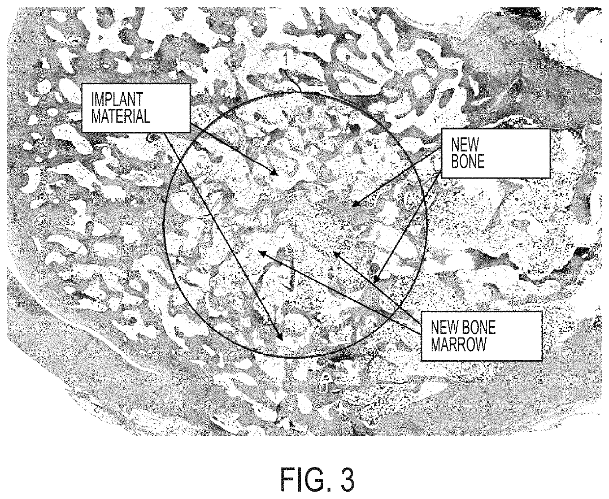 Treatment of skeletal voids with implantable substrate hydrated with bone marrow concentrate