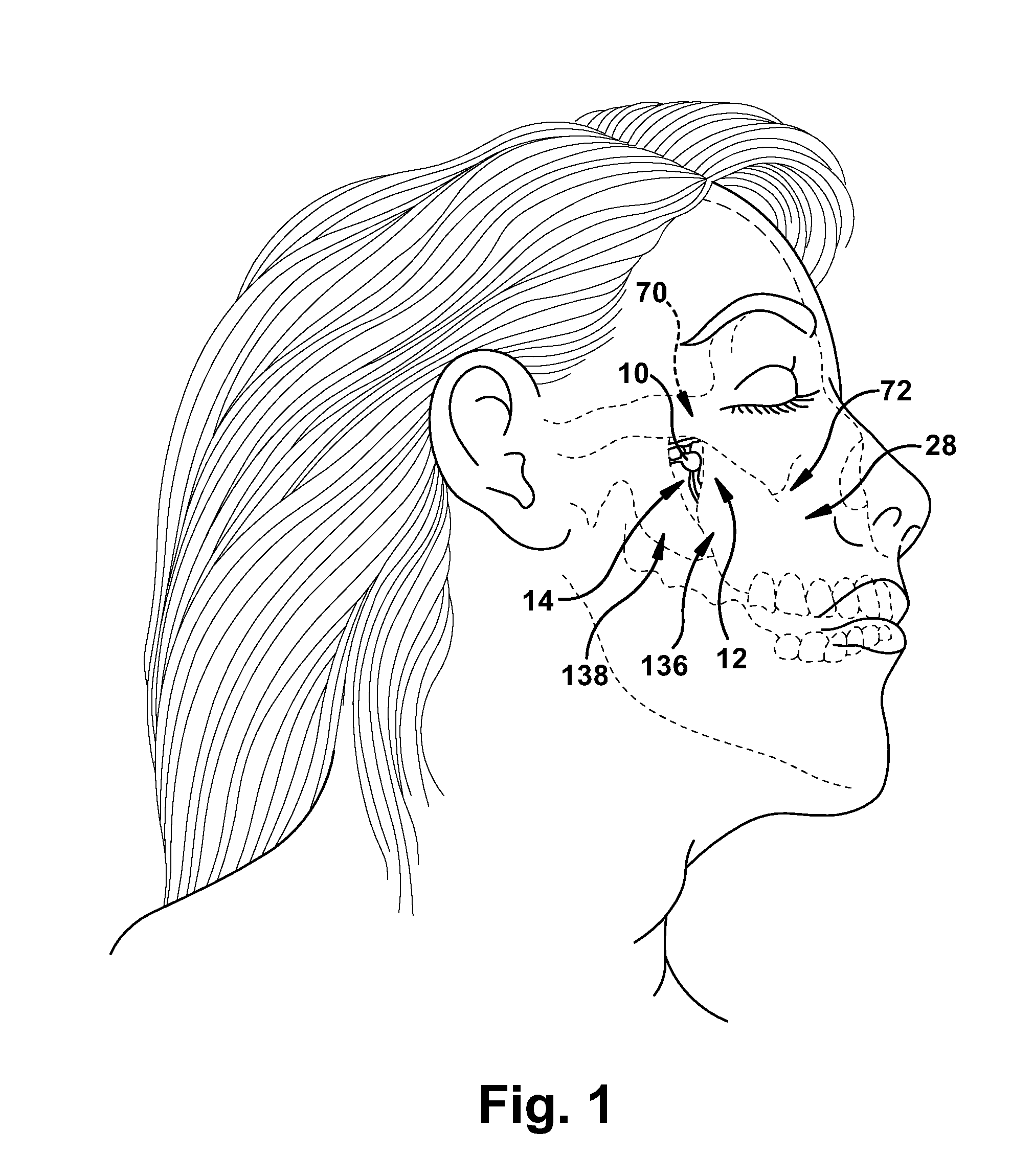 Surgical tools to facilitate delivery of a neurostimulator into the pterygopalatine fossa