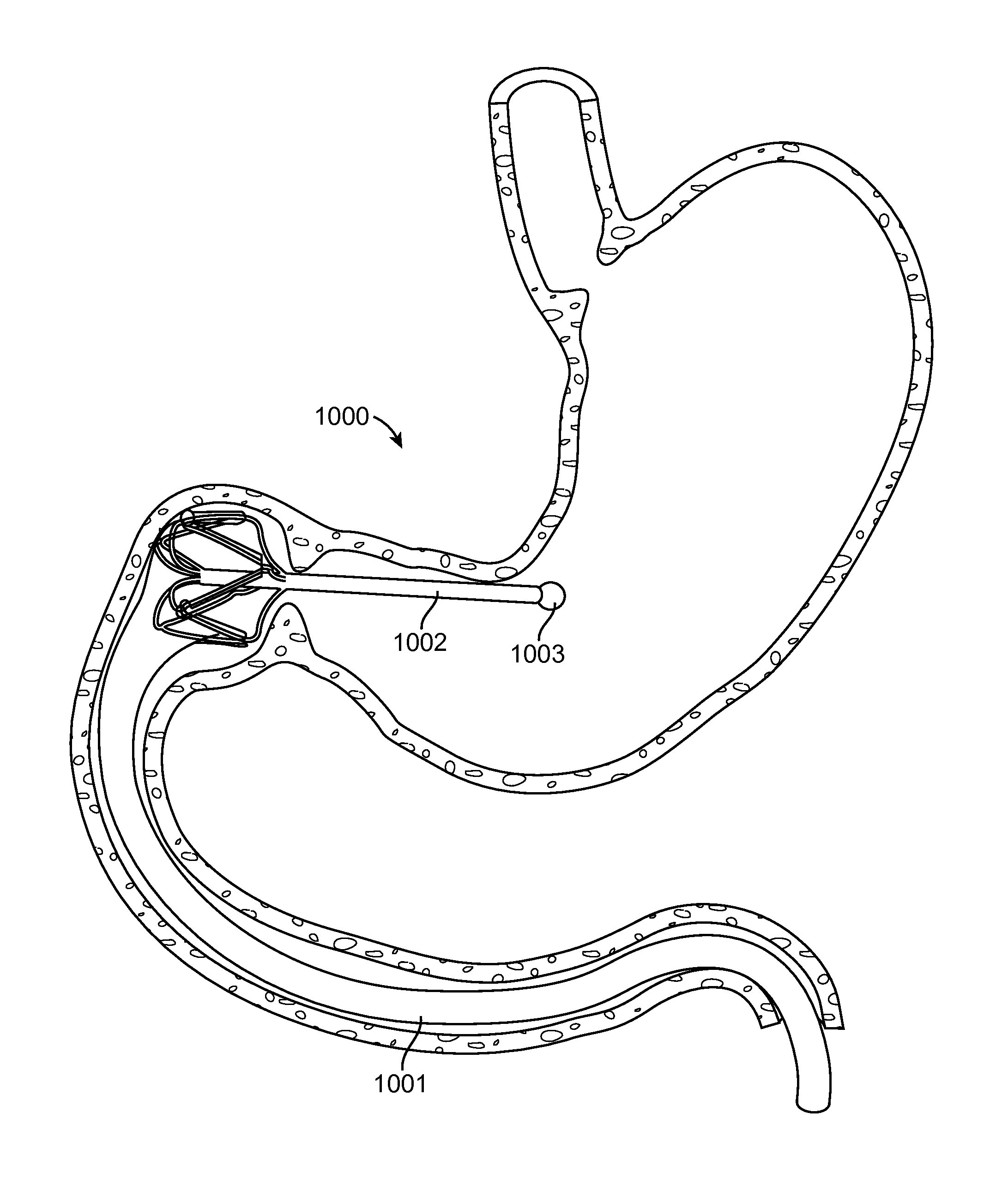 Intragastric implant devices