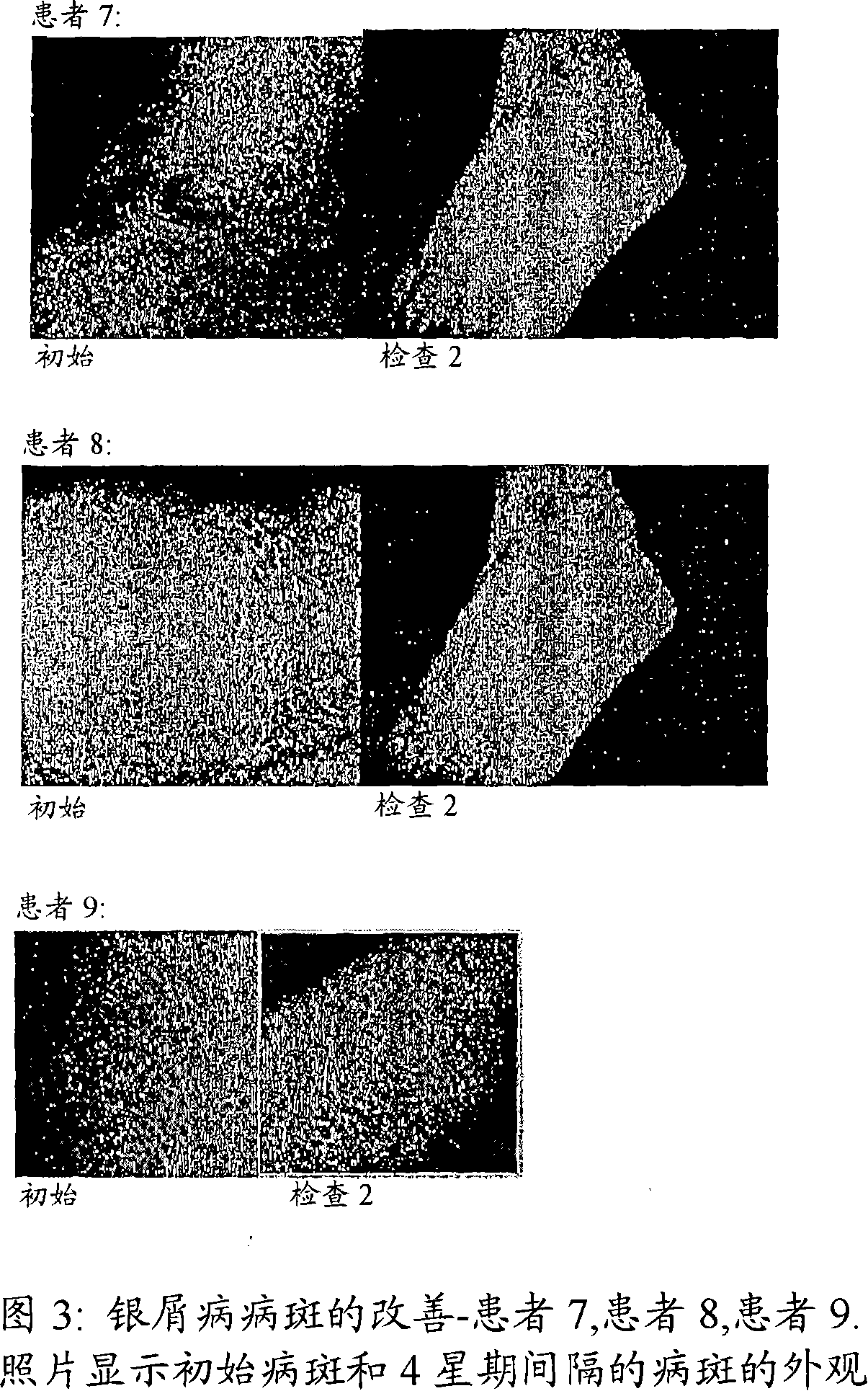 Compositions and methods for the management of hyperproliferative dermatological conditions