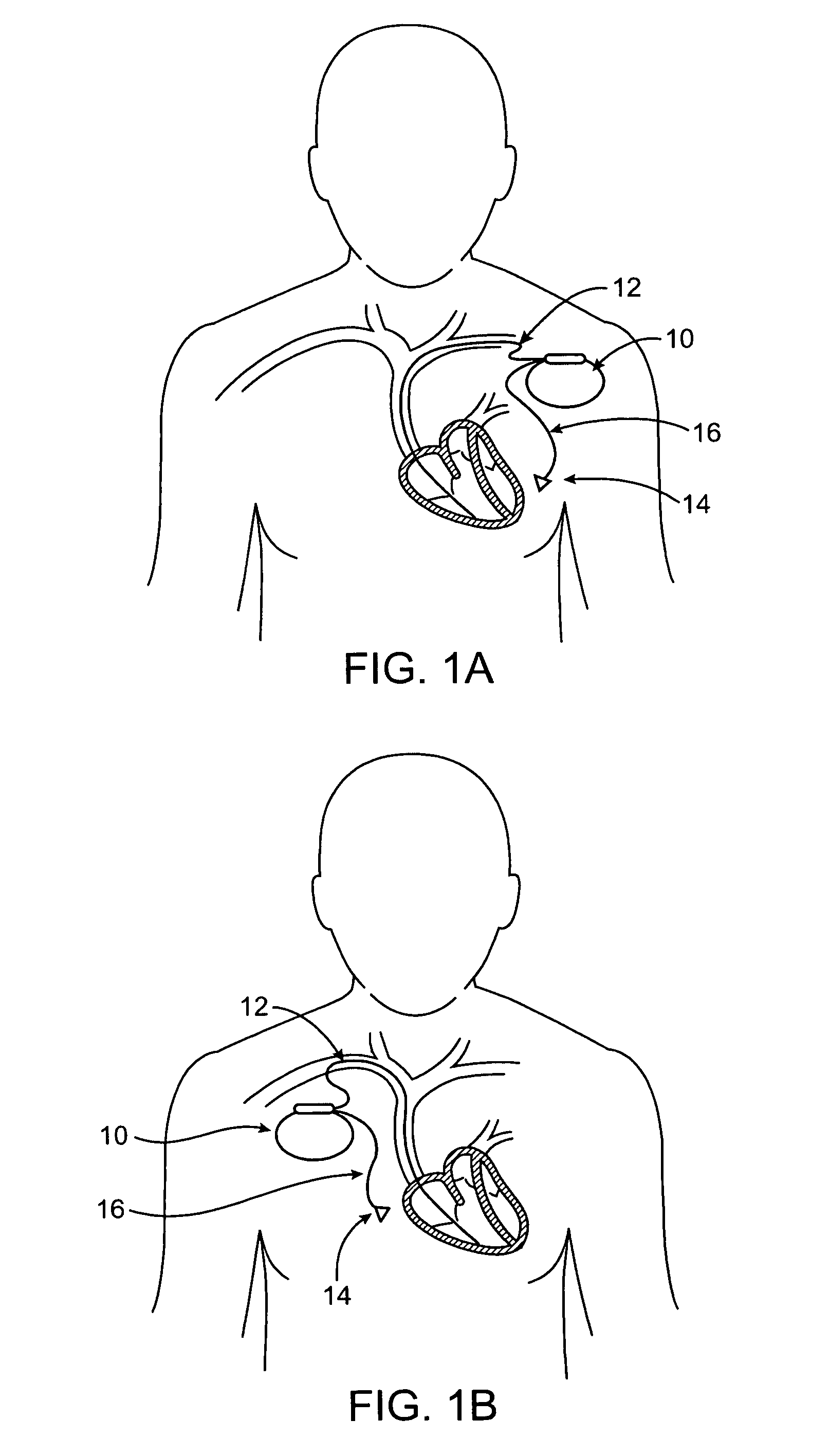 Vibrational therapy device used for resynchronization pacing in a treatment for heart failure