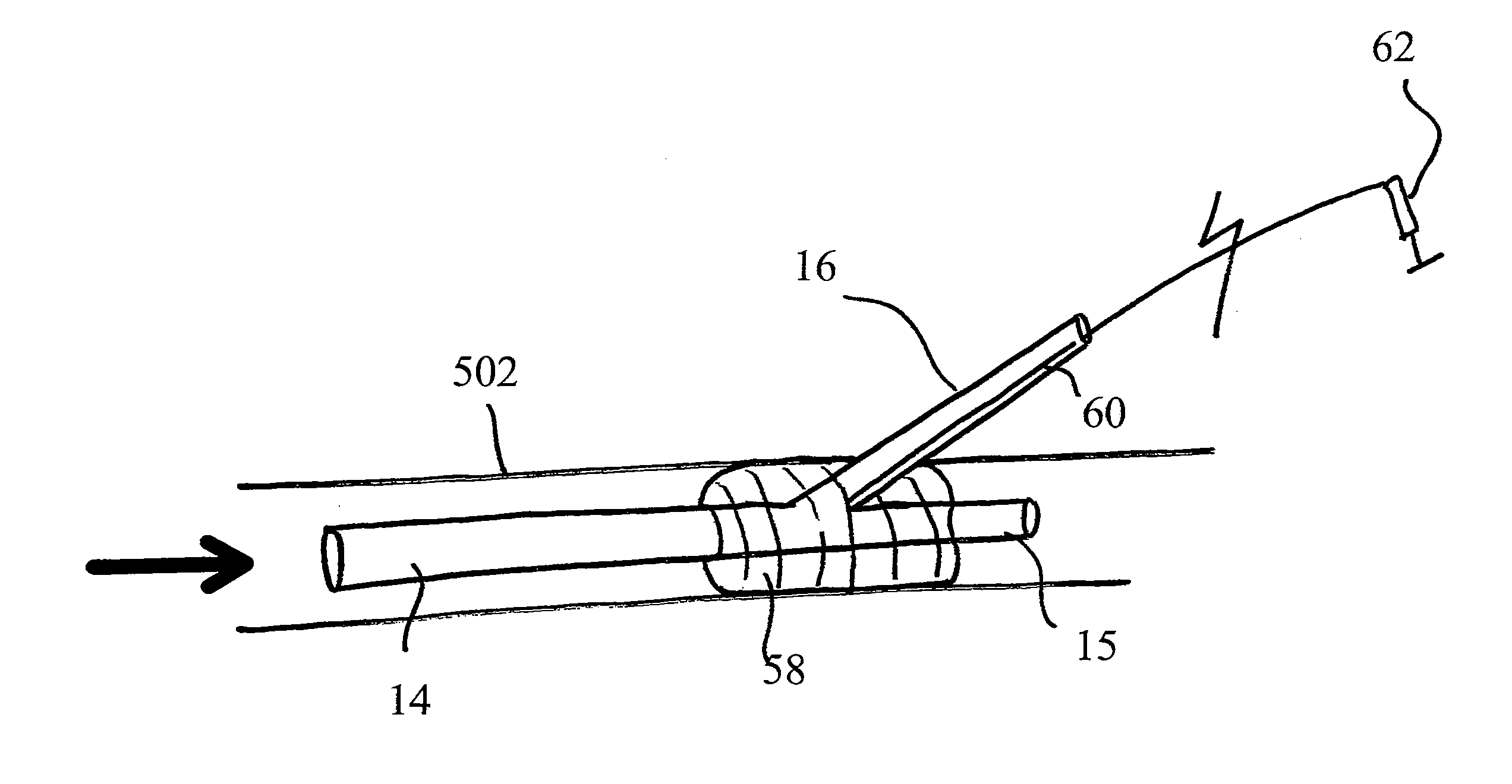 Autoretroperfusion devices and systems