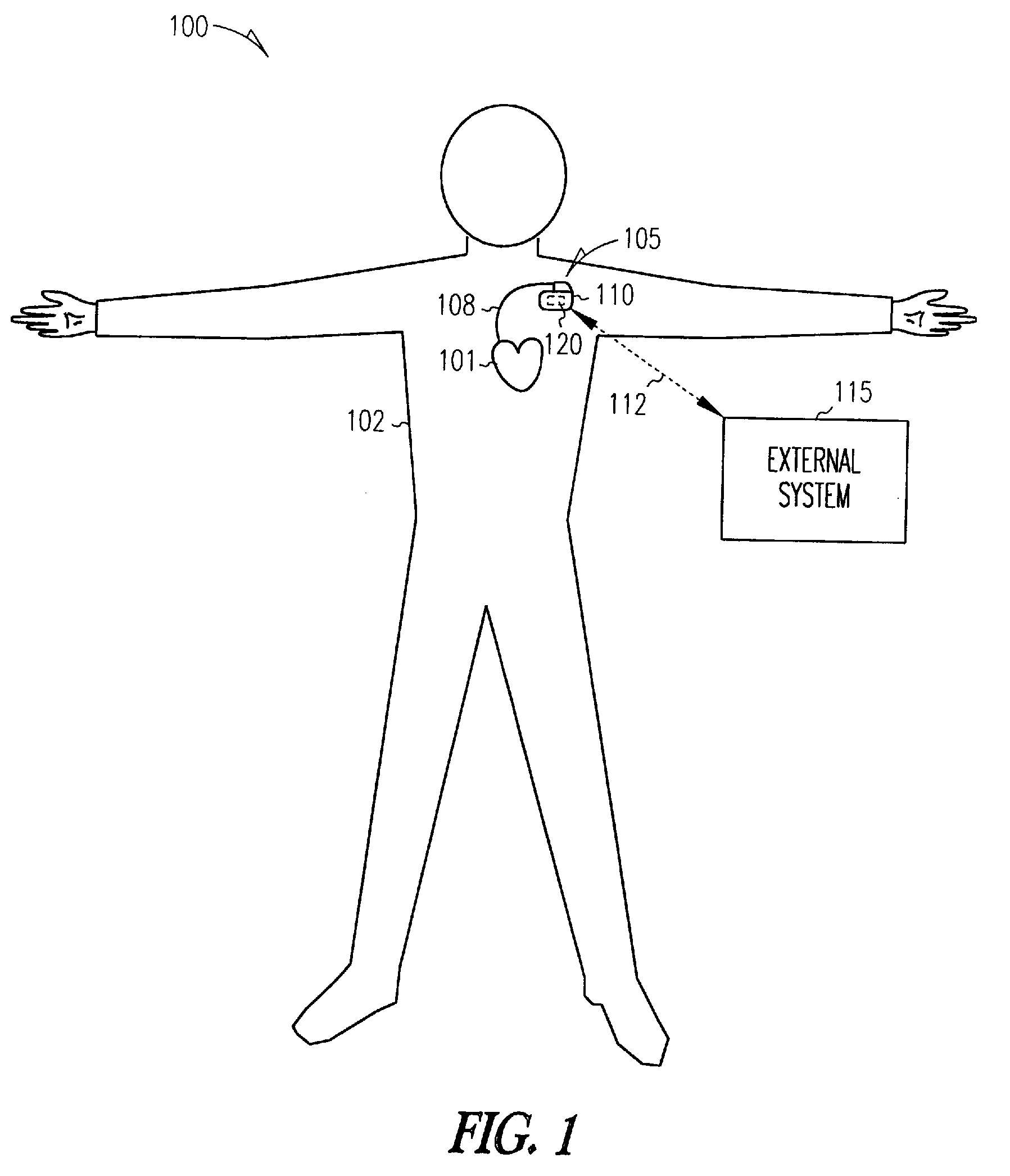 Method and apparatus for initiating and delivering cardiac protection pacing