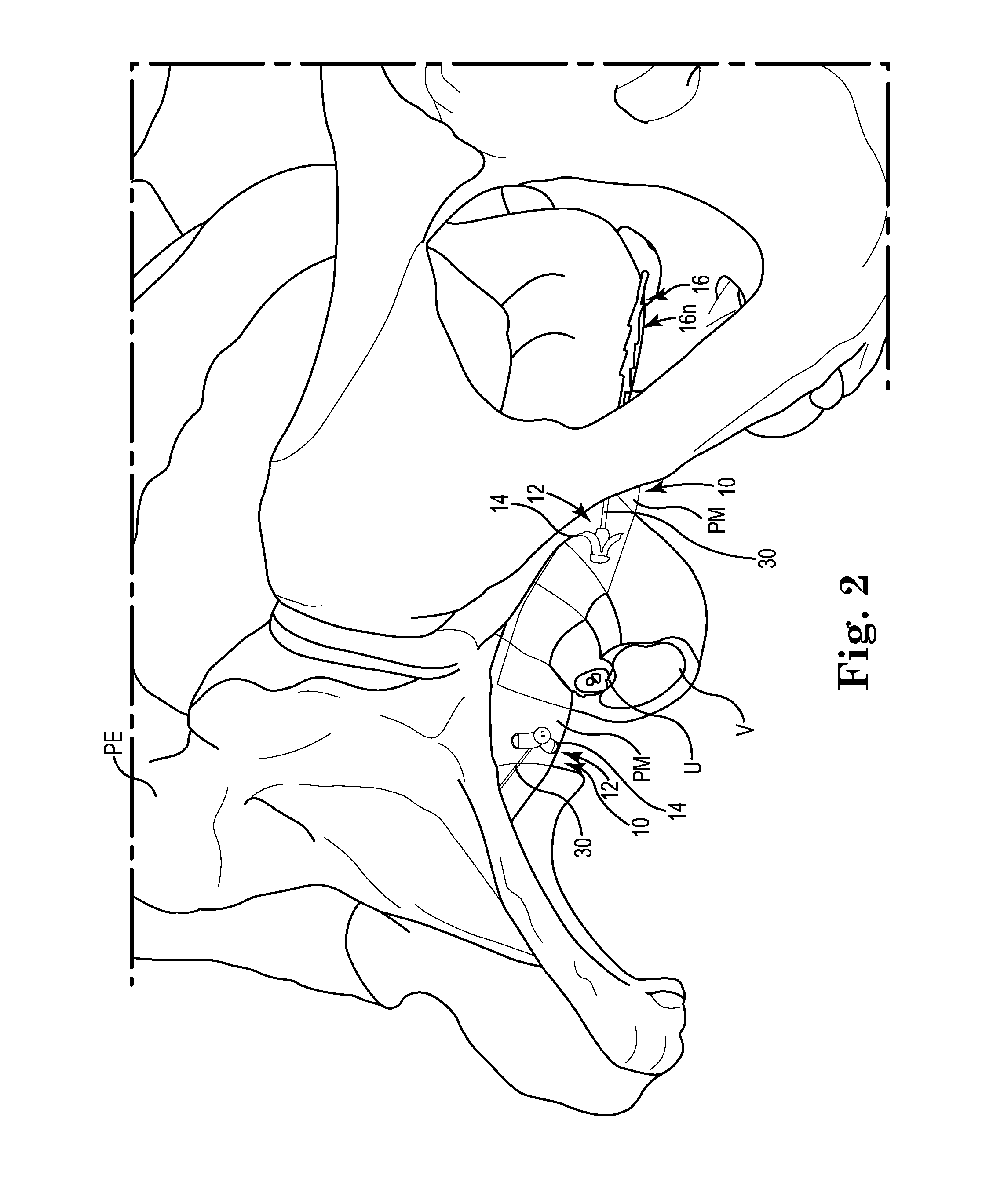 Pelvic Implant System and Method