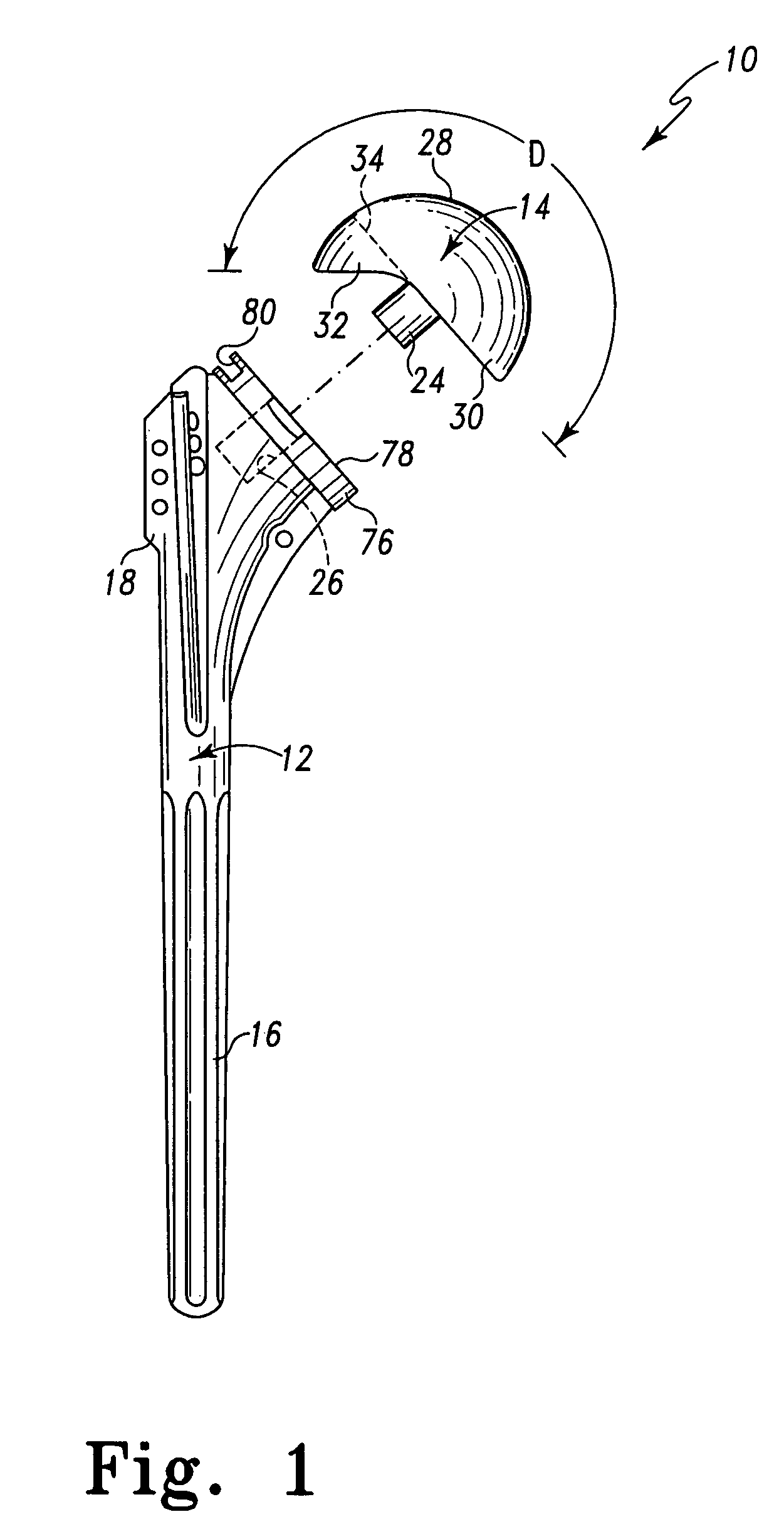 Bone resection apparatus