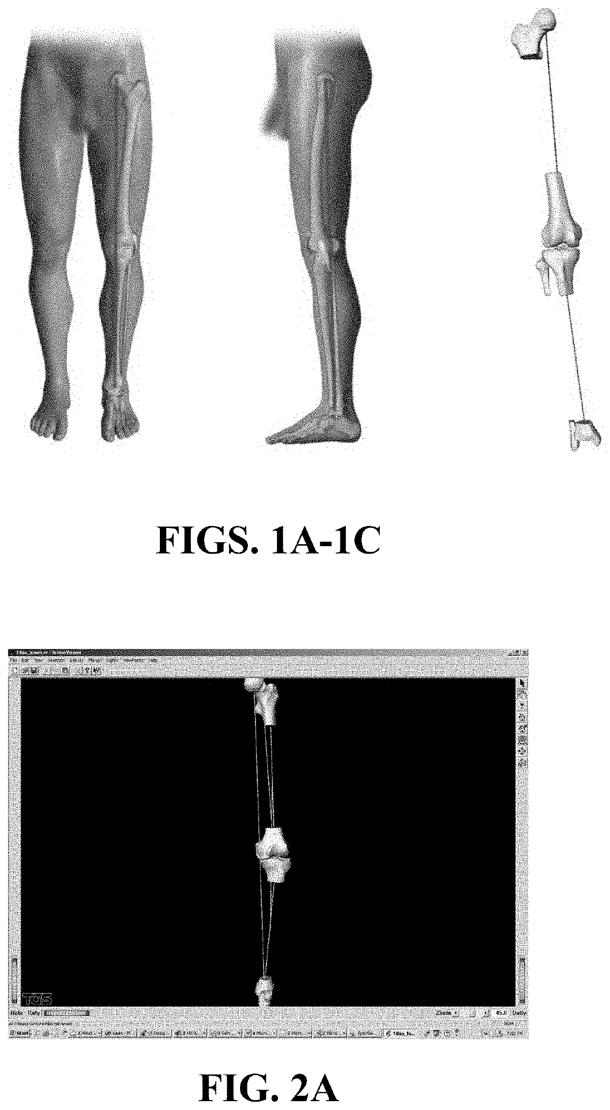 Kinematic Alignment and Novel Femoral and Tibial Prosthetics