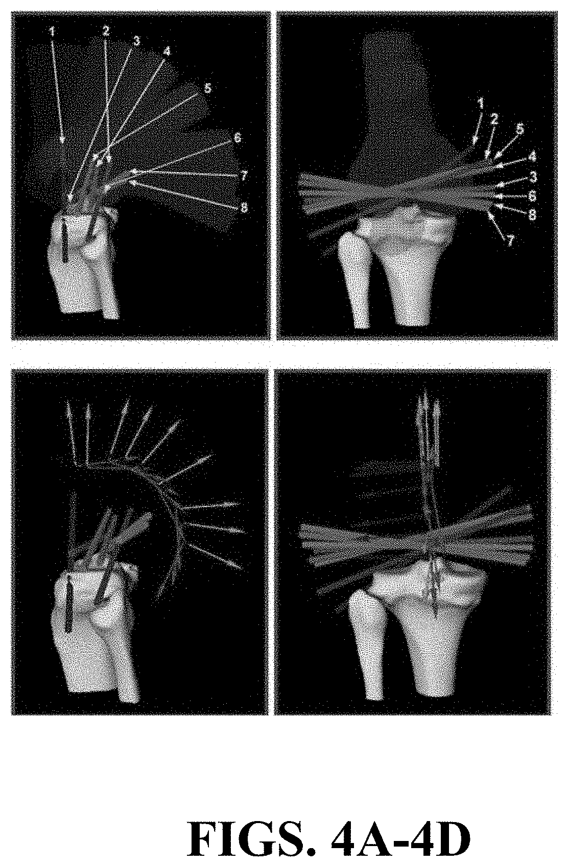 Kinematic Alignment and Novel Femoral and Tibial Prosthetics