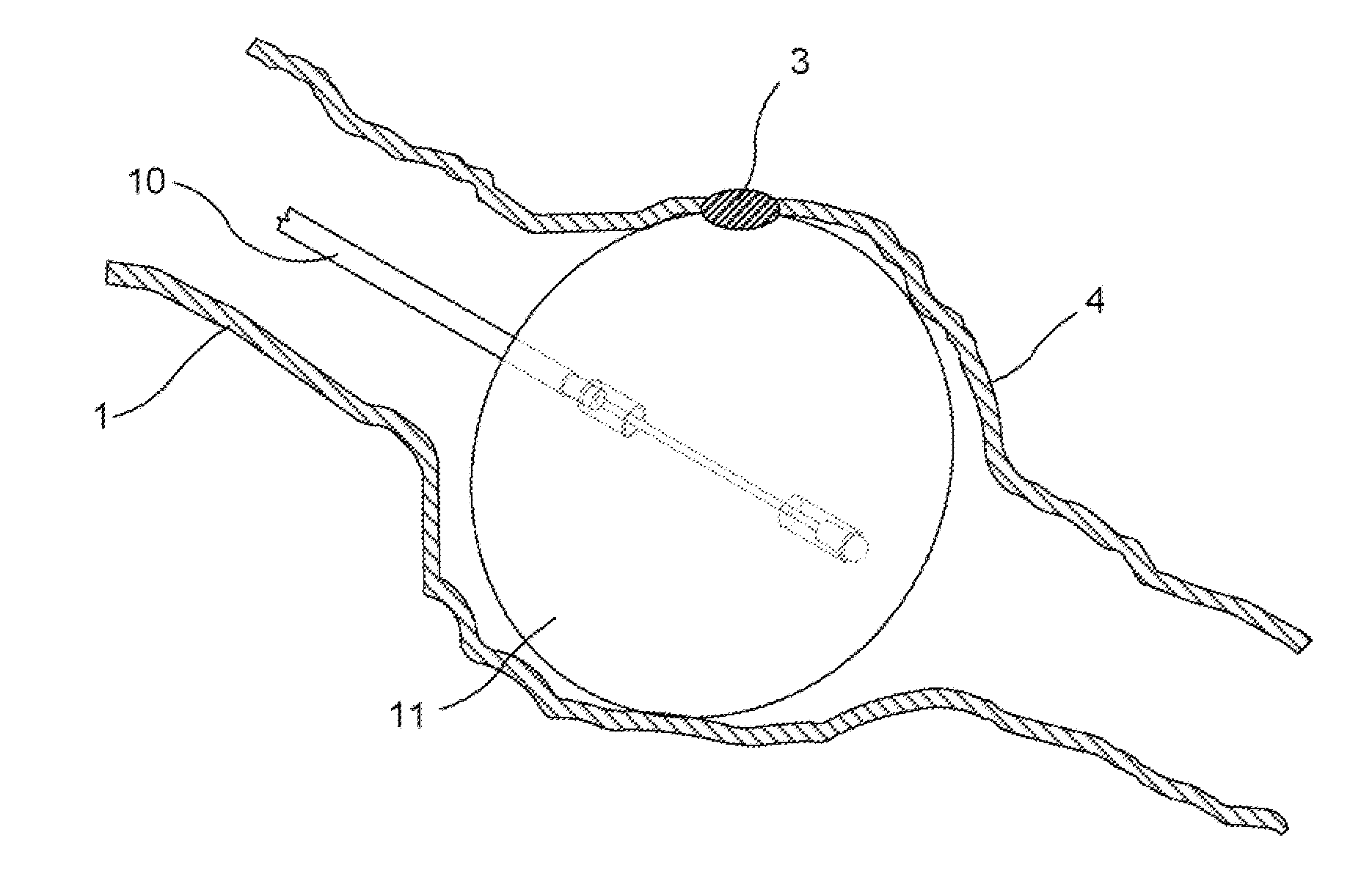 Detachable balloon catheter