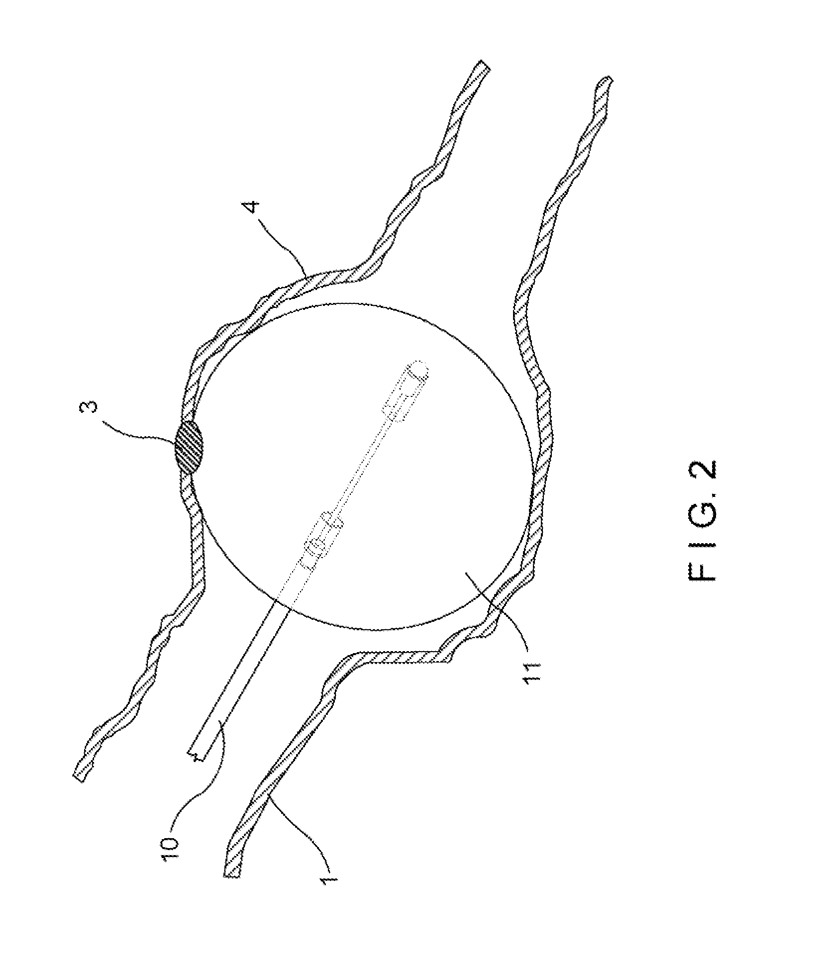 Detachable balloon catheter