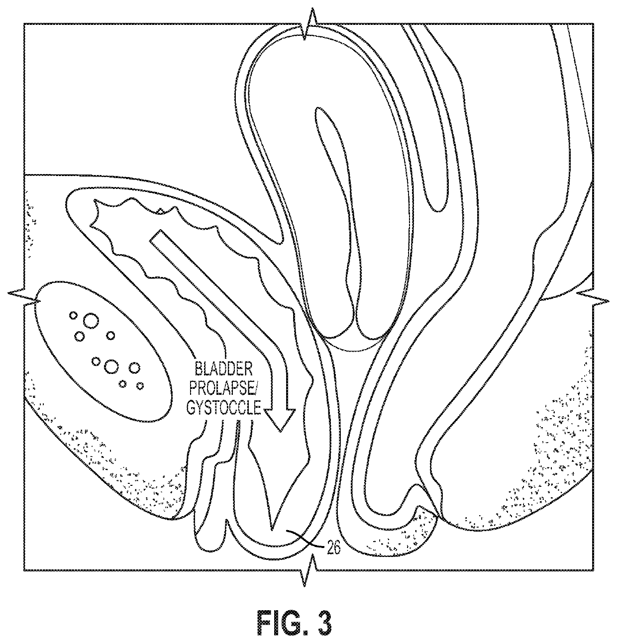 Intravaginal support devices and methods