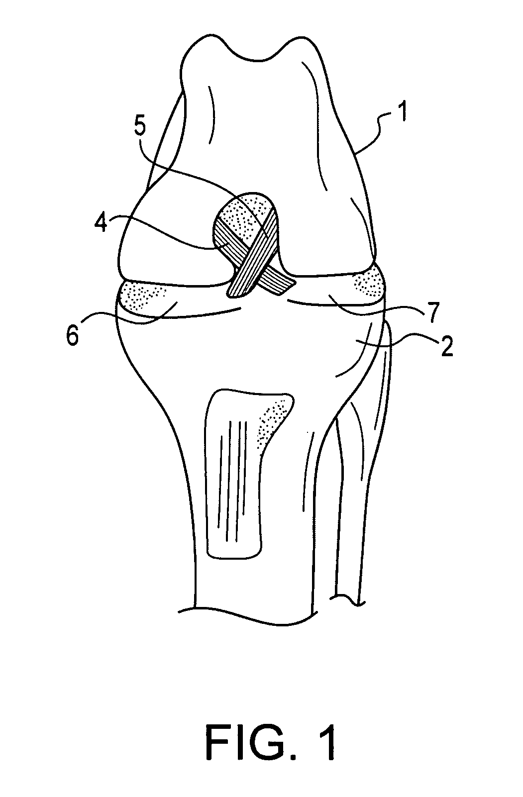 Method and suture-button construct for stabilization of cranial cruciate ligament deficient stifle