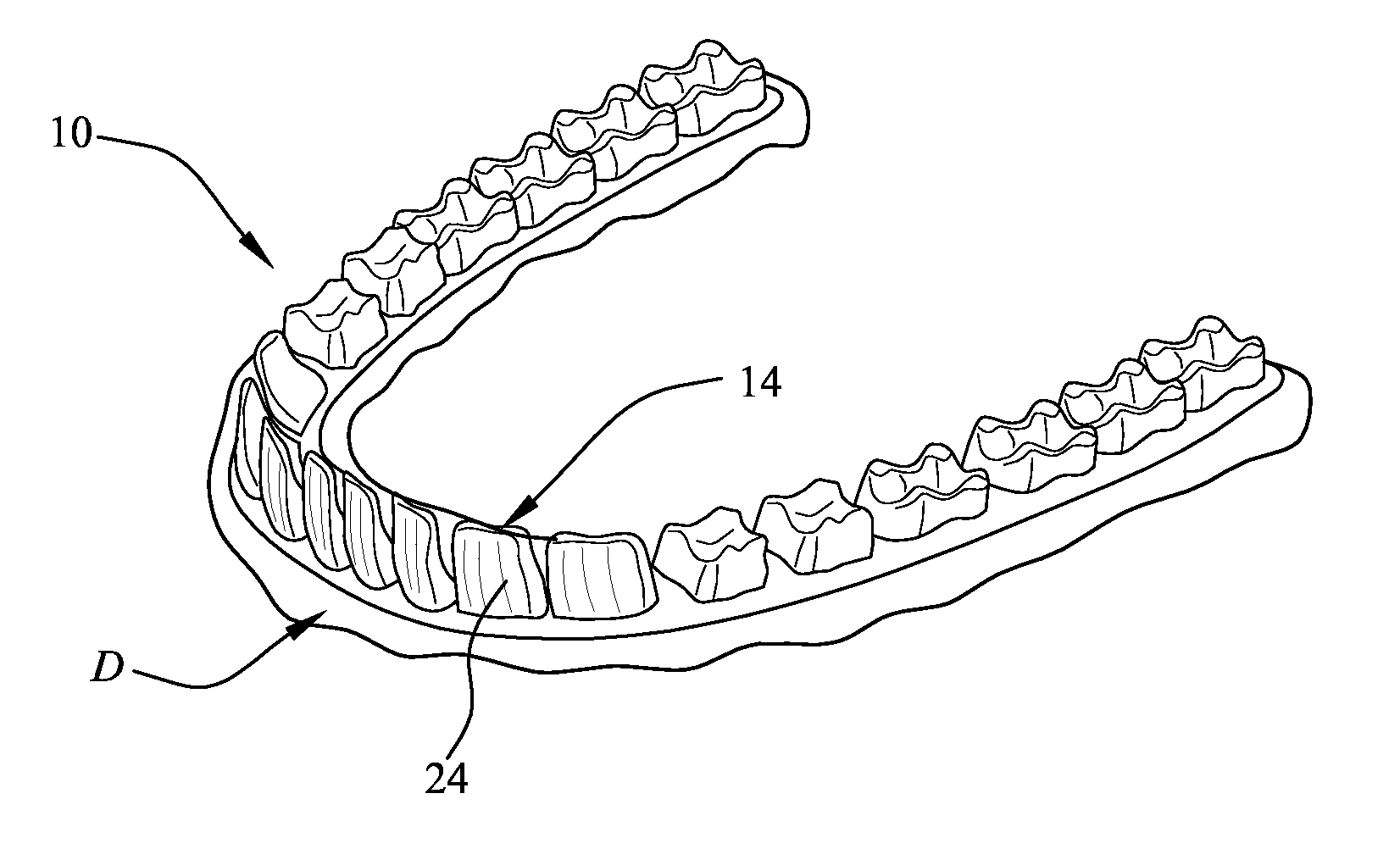 Enhancement to dental alignment device