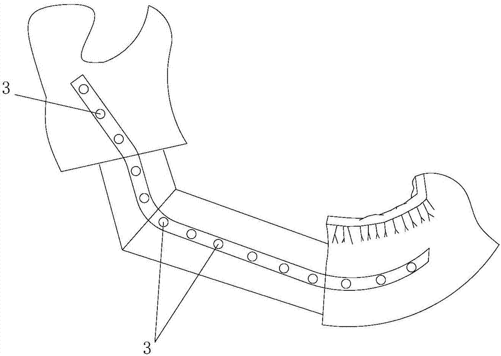 Production method of 3D printing fibula reconstruction jaw surgical tool combining bone excision with titanium-plate positioning