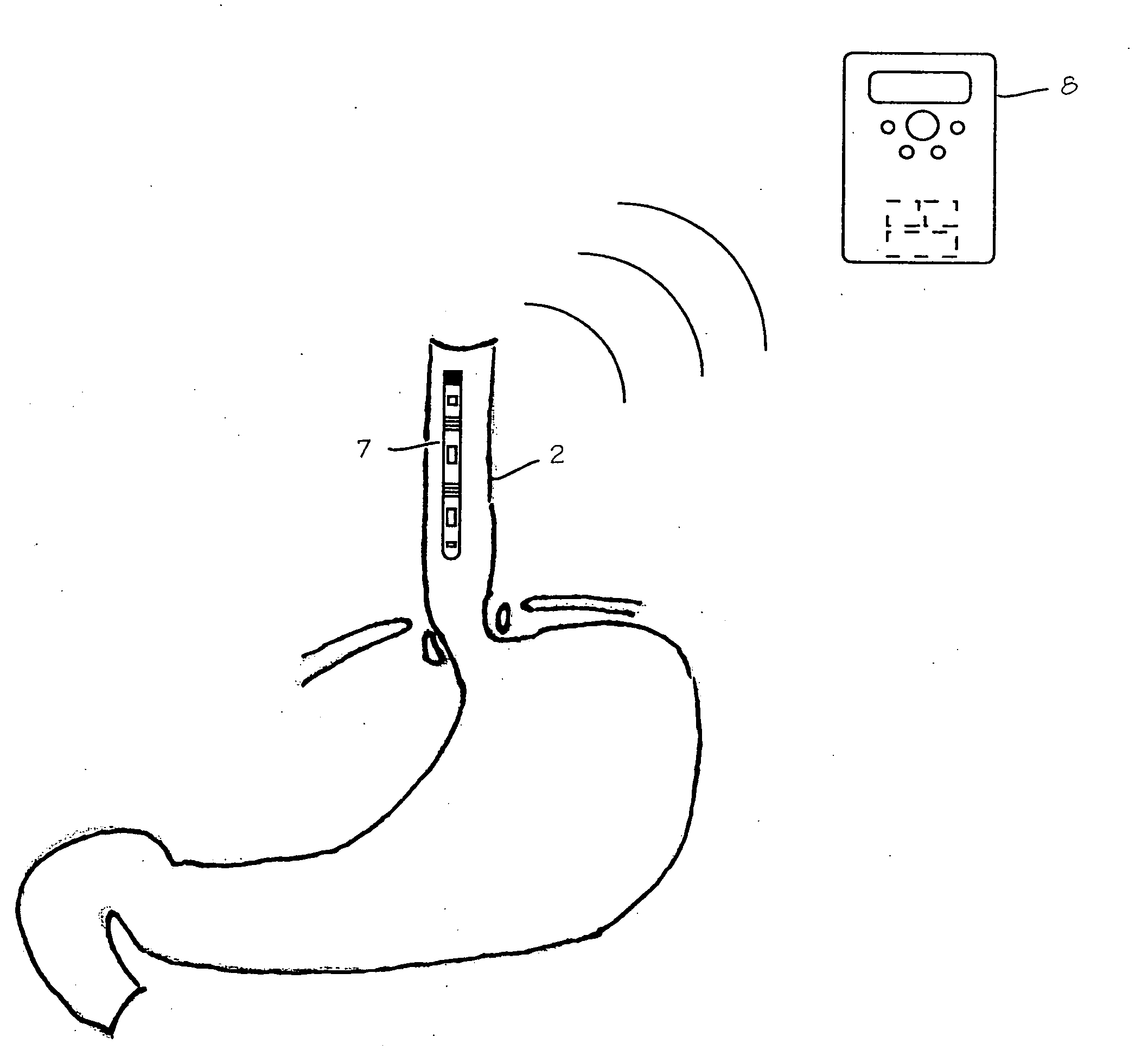 Wireless ambulatory gastrointestinal monitoring system