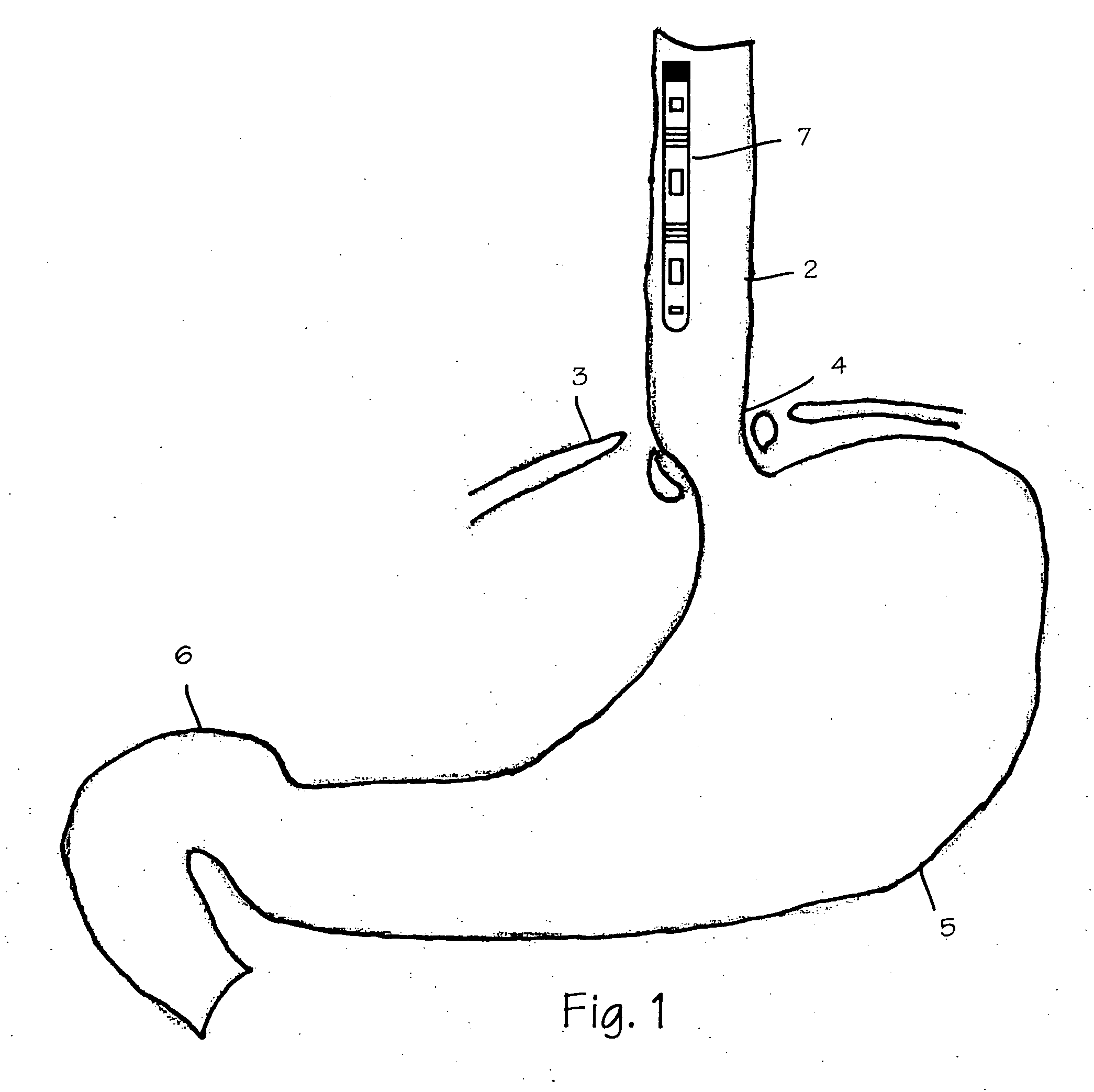 Wireless ambulatory gastrointestinal monitoring system