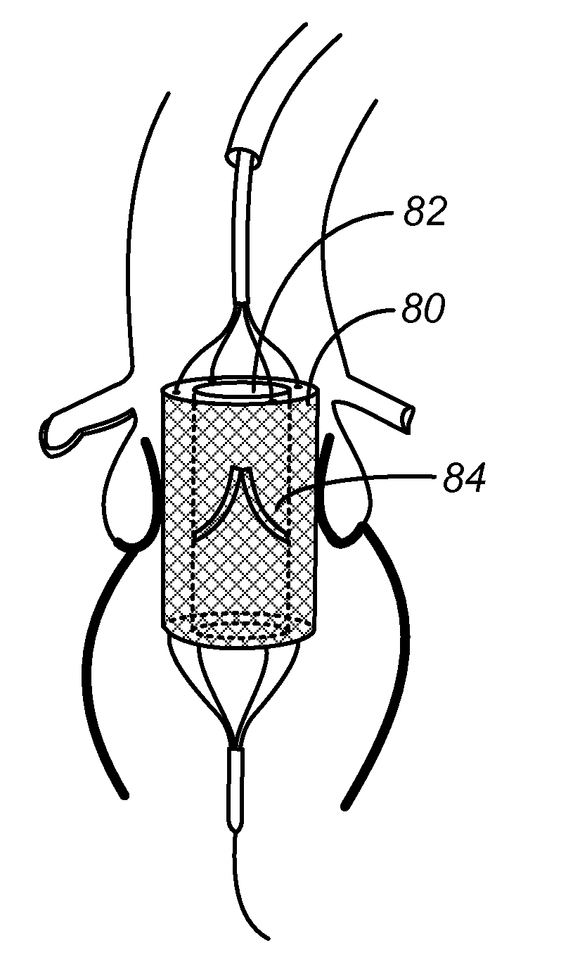 Device and methods for delivery and transfer of temporary radiopaque element