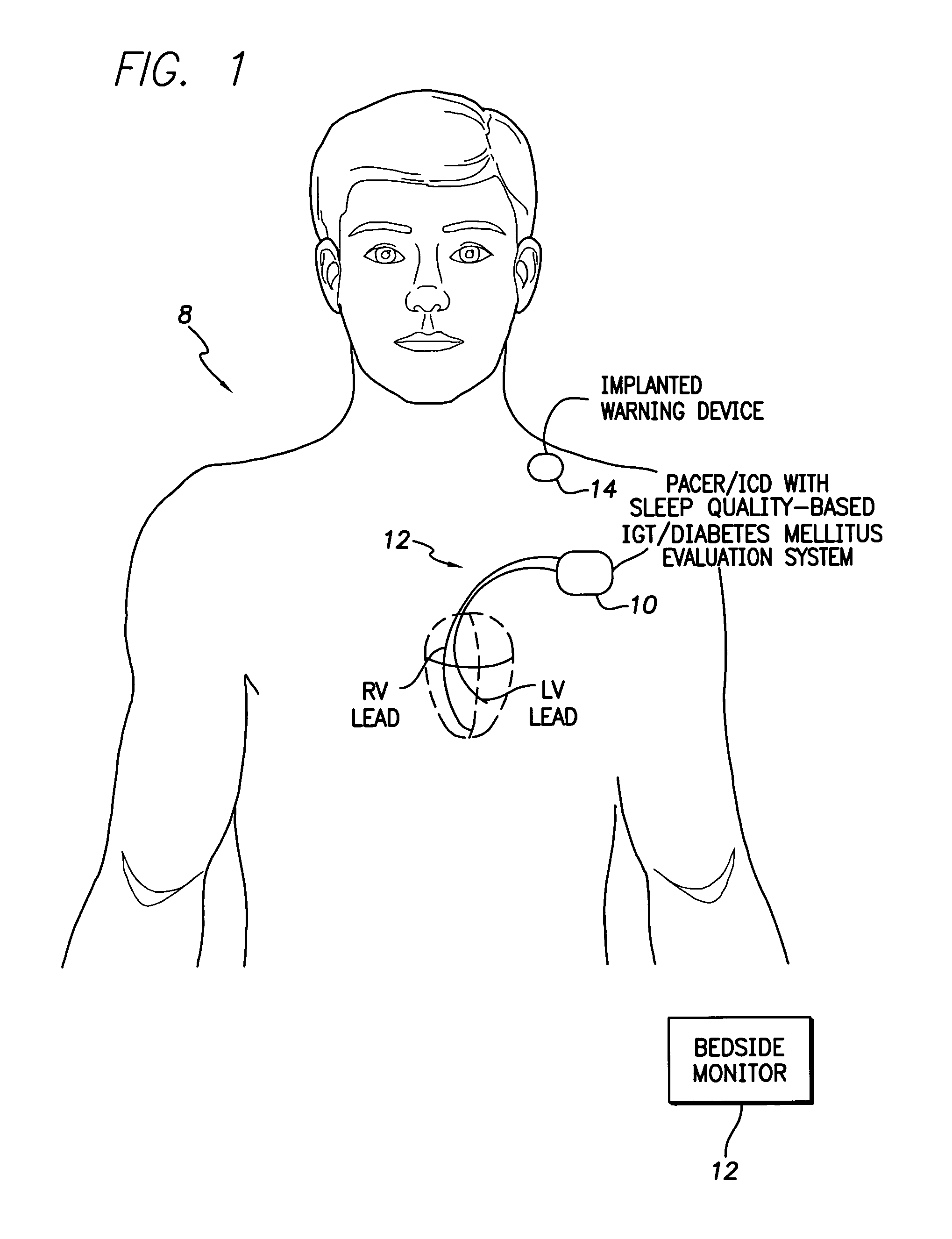 System and method for evaluating impaired glucose tolerance and diabetes mellitus within a patient using an implantable medical device