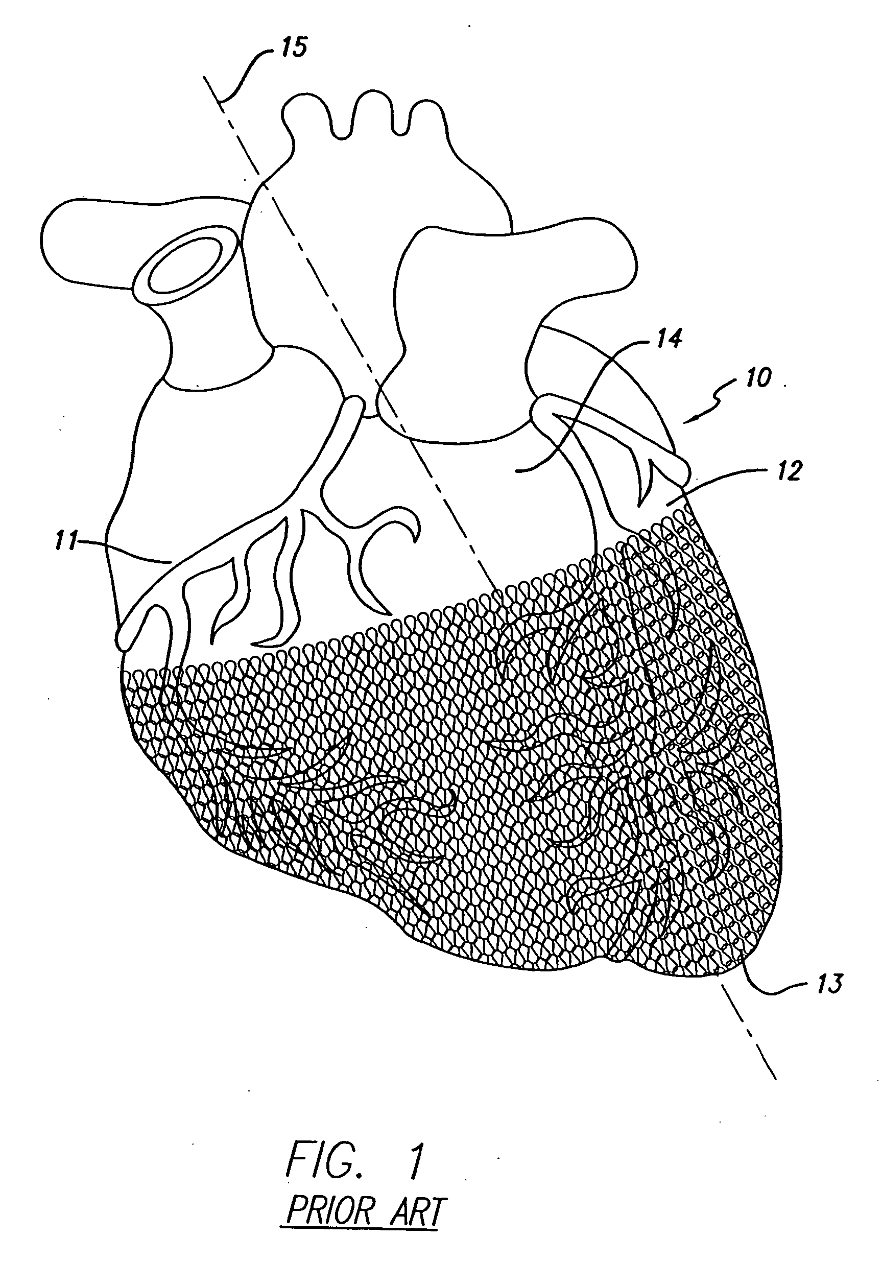 Cardiac harness having electrodes and epicardial leads