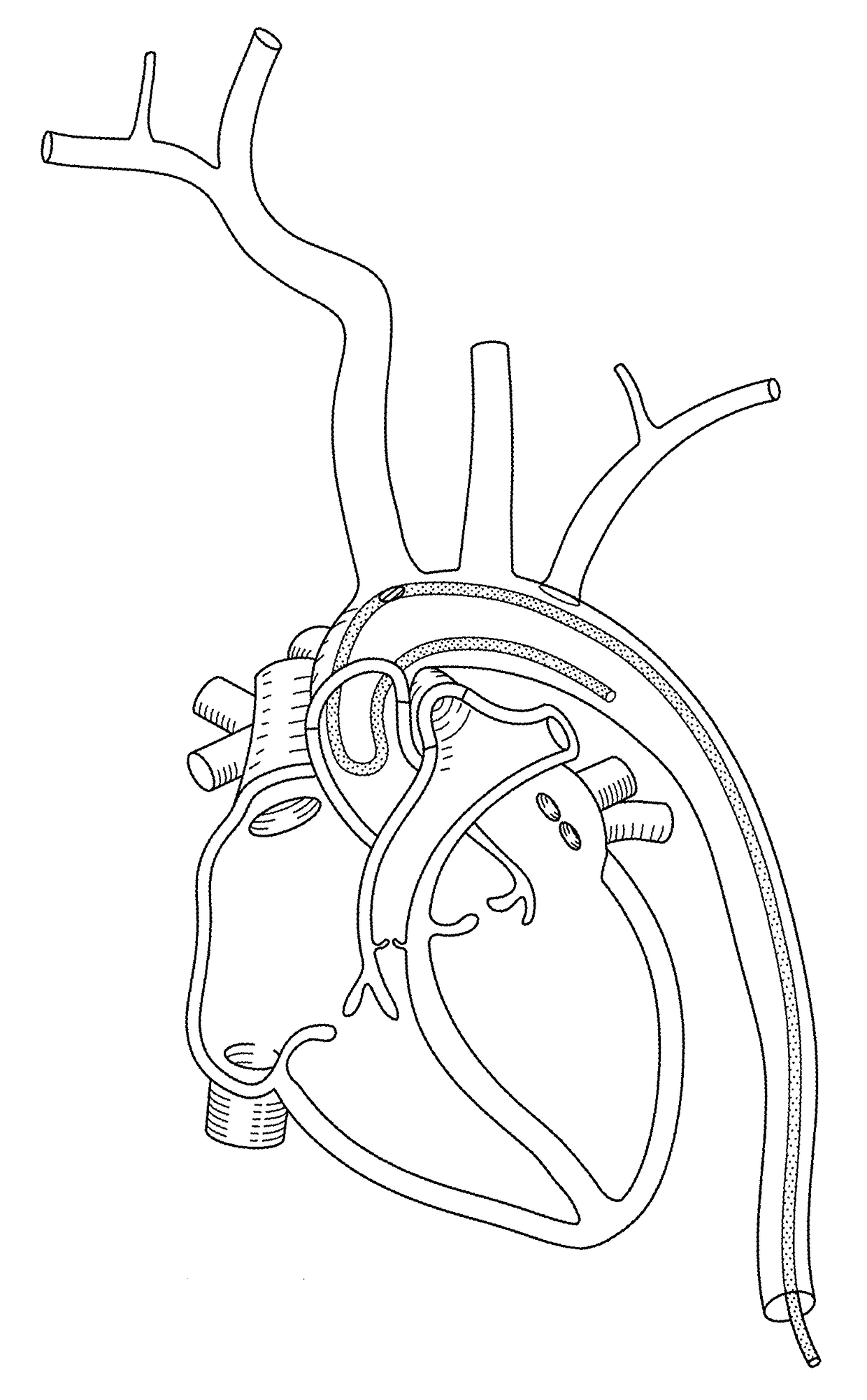 Vessel access catheter