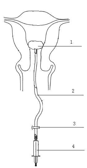 Cervical ripening ball sac