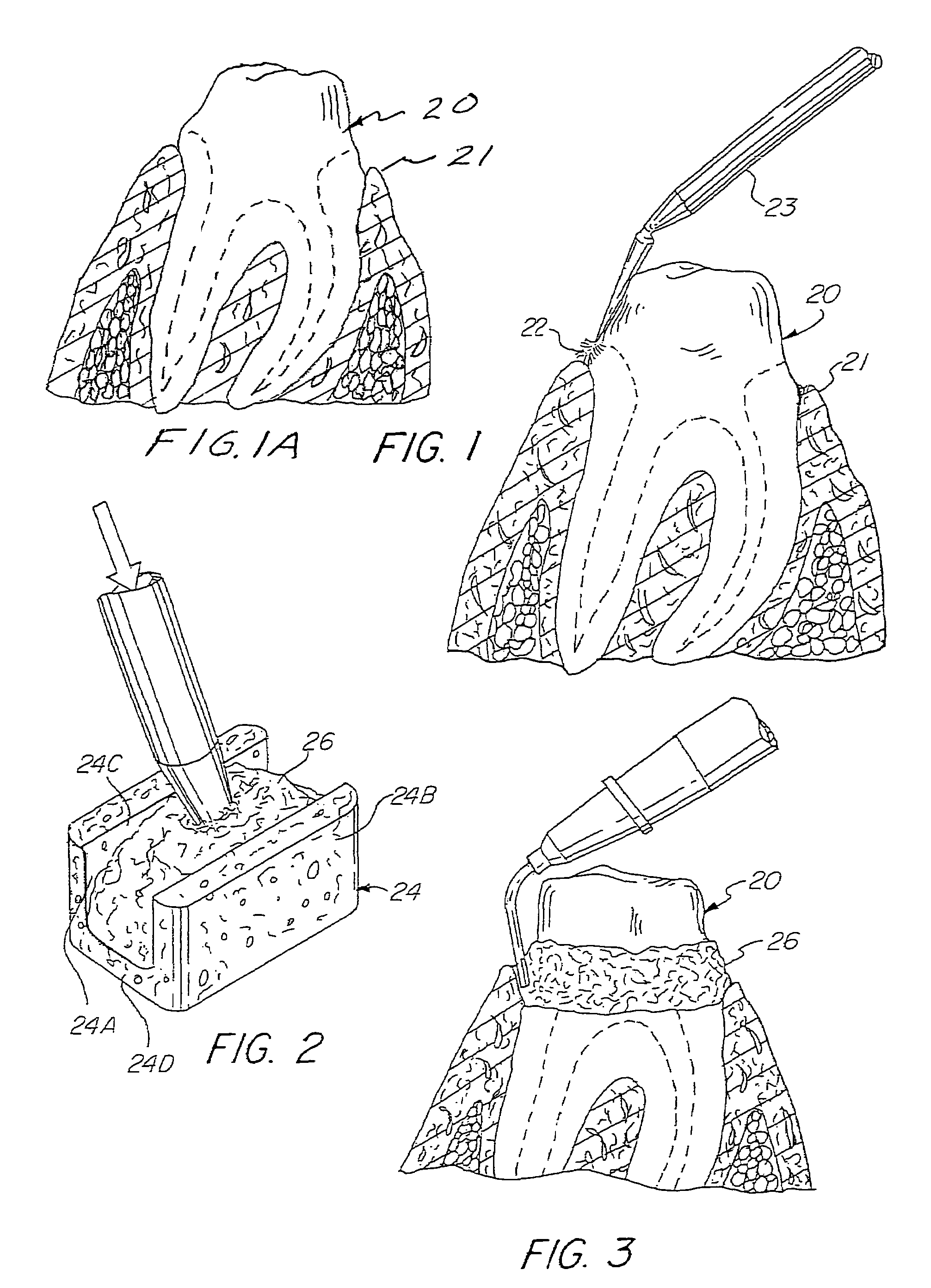 Preloaded dental dam and method for gingival tissue retraction