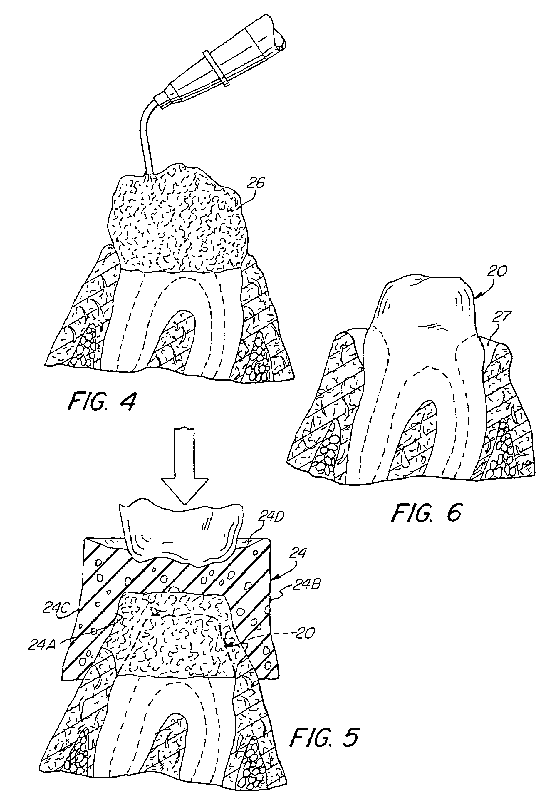 Preloaded dental dam and method for gingival tissue retraction